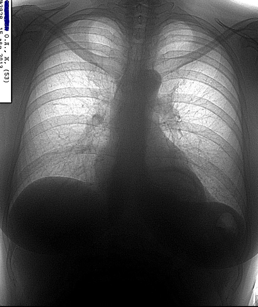 Флюорография 2. Грыжа пищеводного отверстия диафрагмы на флюорографии. Диафрагмальная грыжа на рентгене грудной клетки. Диафрагмальная грыжа рентген снимок. ГПОД диафрагмы рентген.