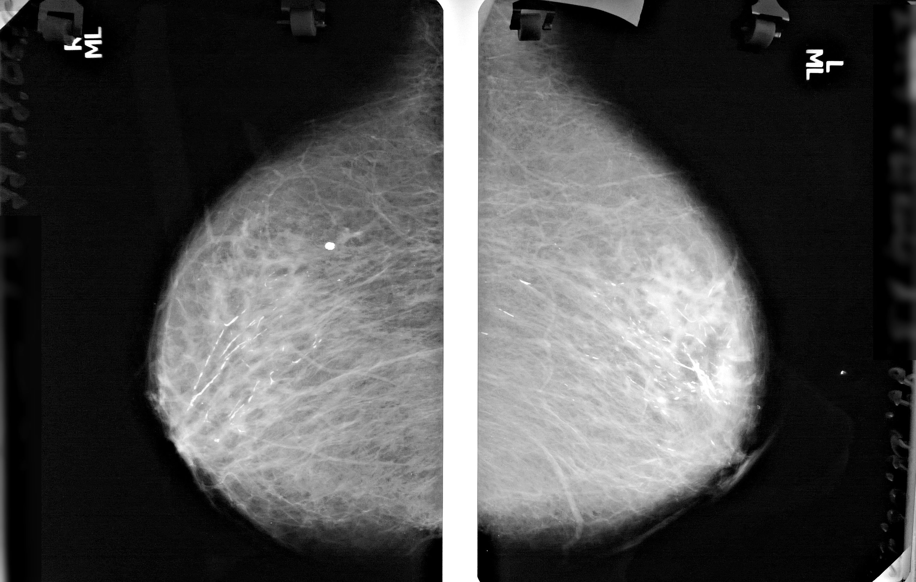 доброкачественные опухоли в груди у женщин фото 109