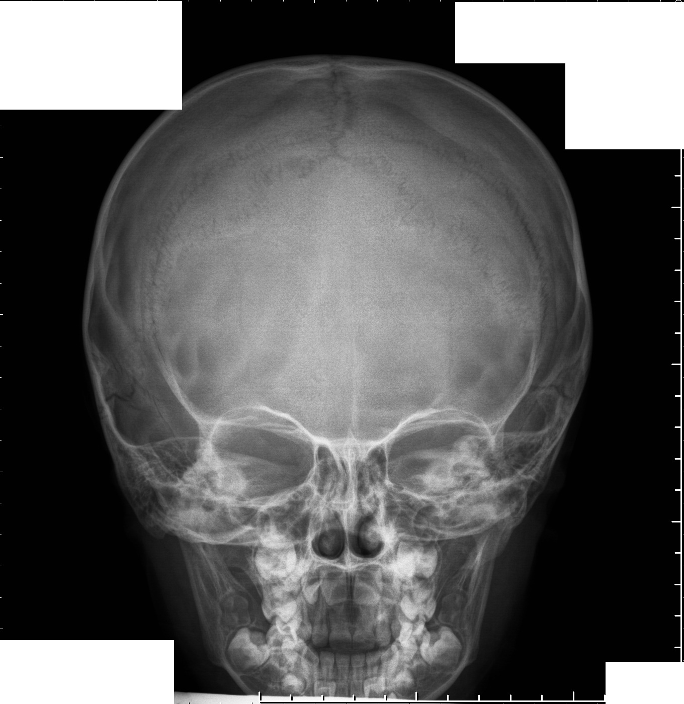 Рентгенография черепа (краниография