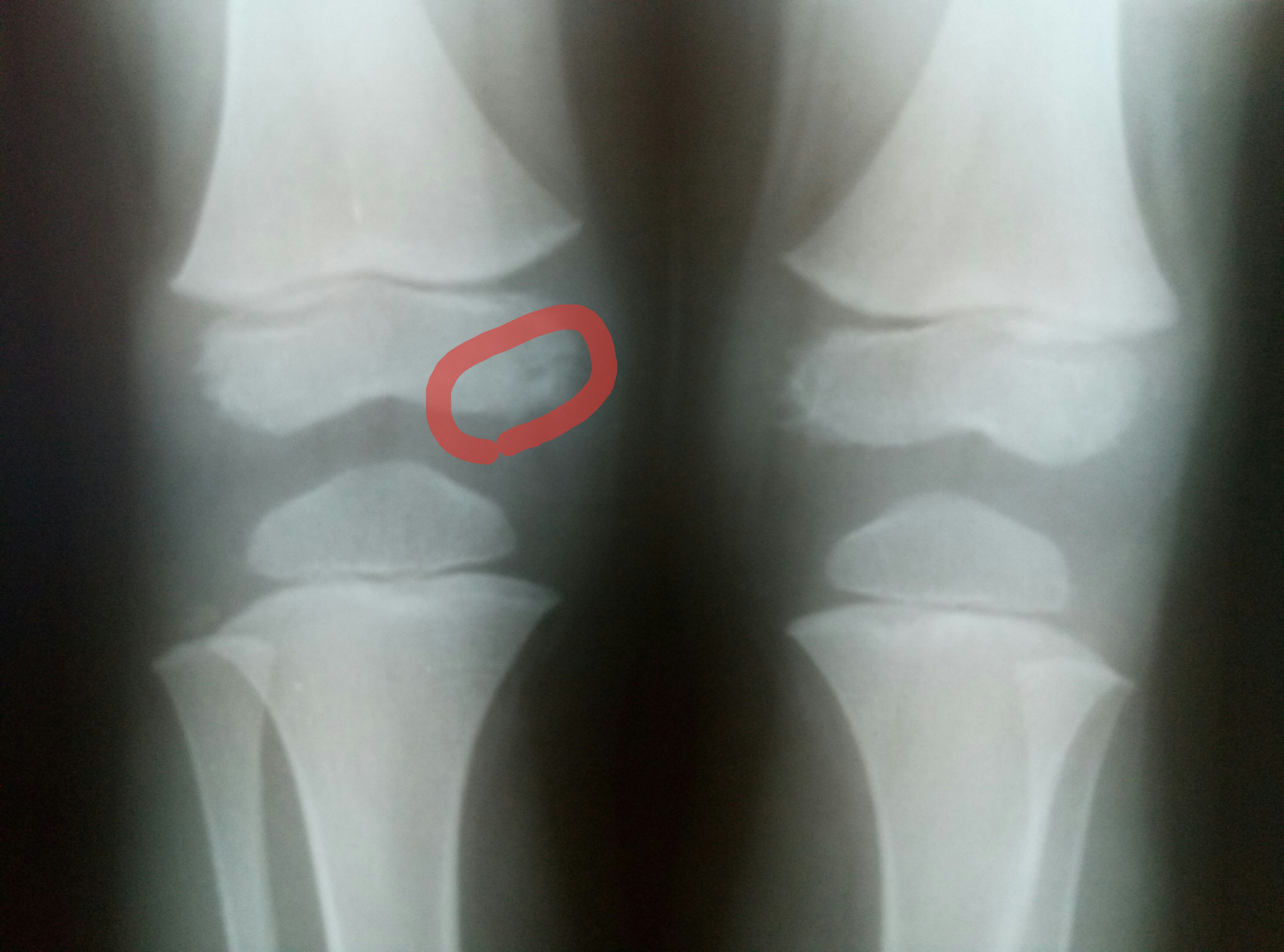 Артрит коленного сустава у детей рентген