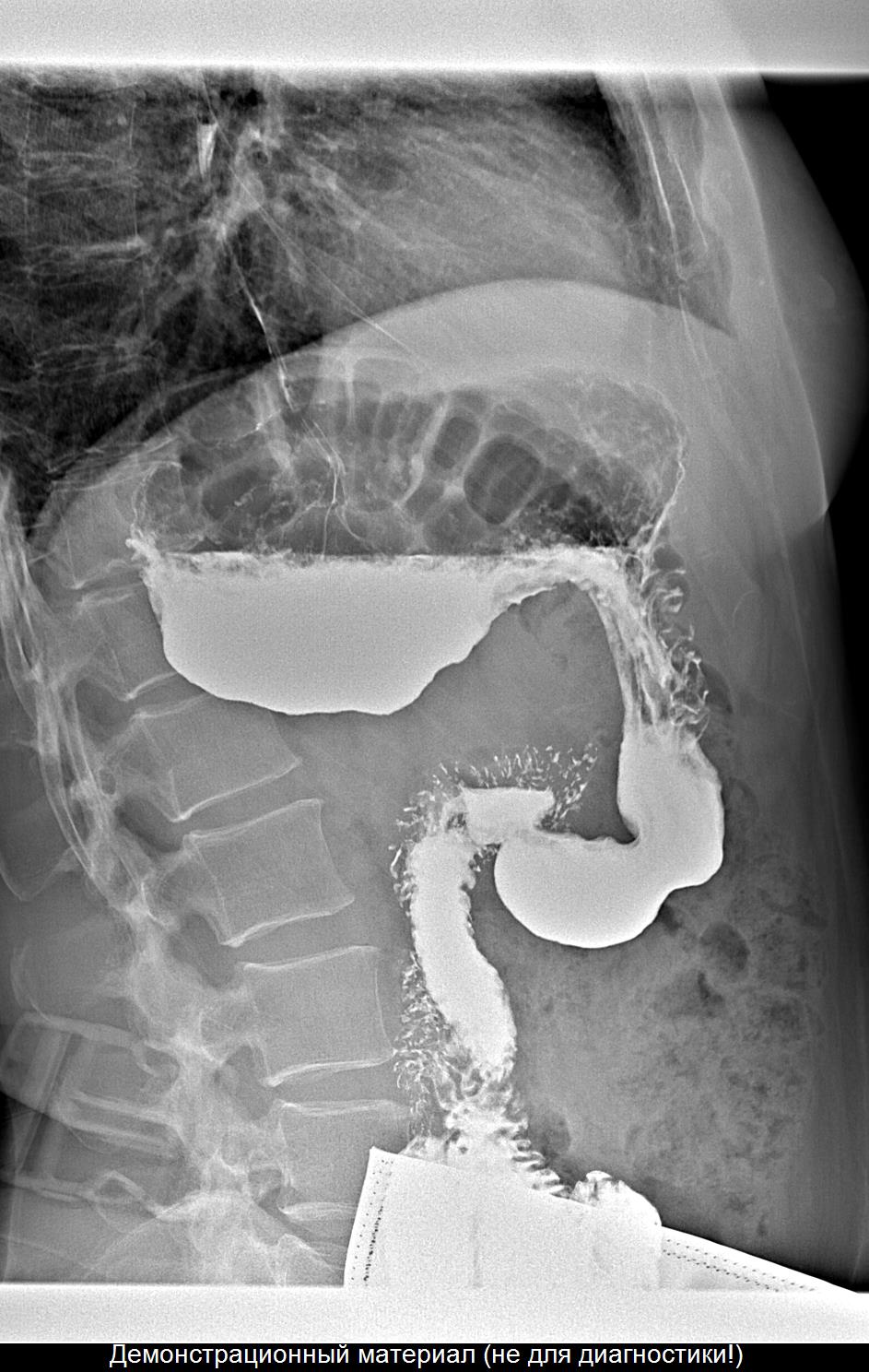 Часы желудка. Перегиб желудка рентген. Каскадный желудок рентген. Каскадная деформация желудка. Каскад желудка рентген.