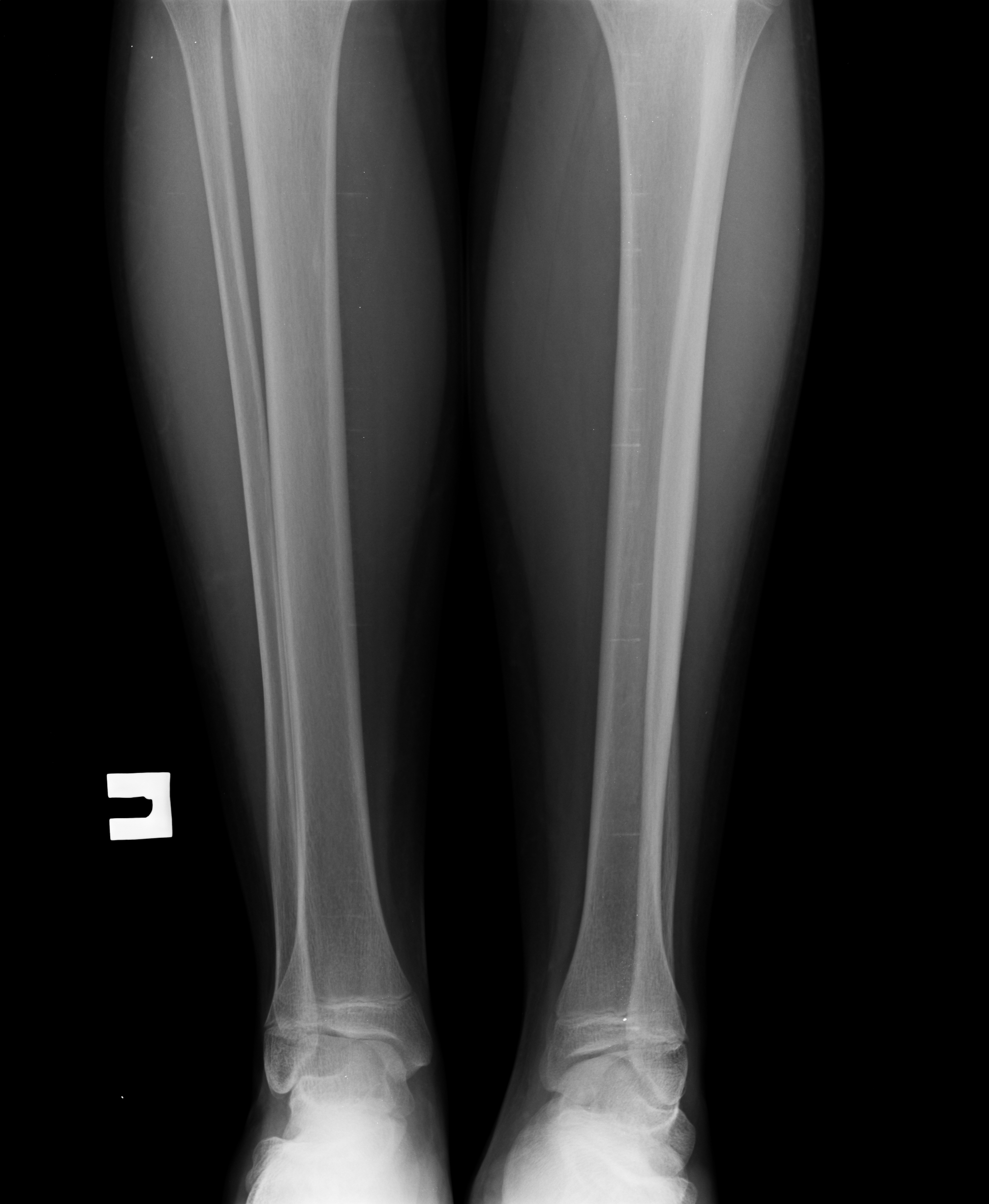 Рентген большеберцовой кости норма