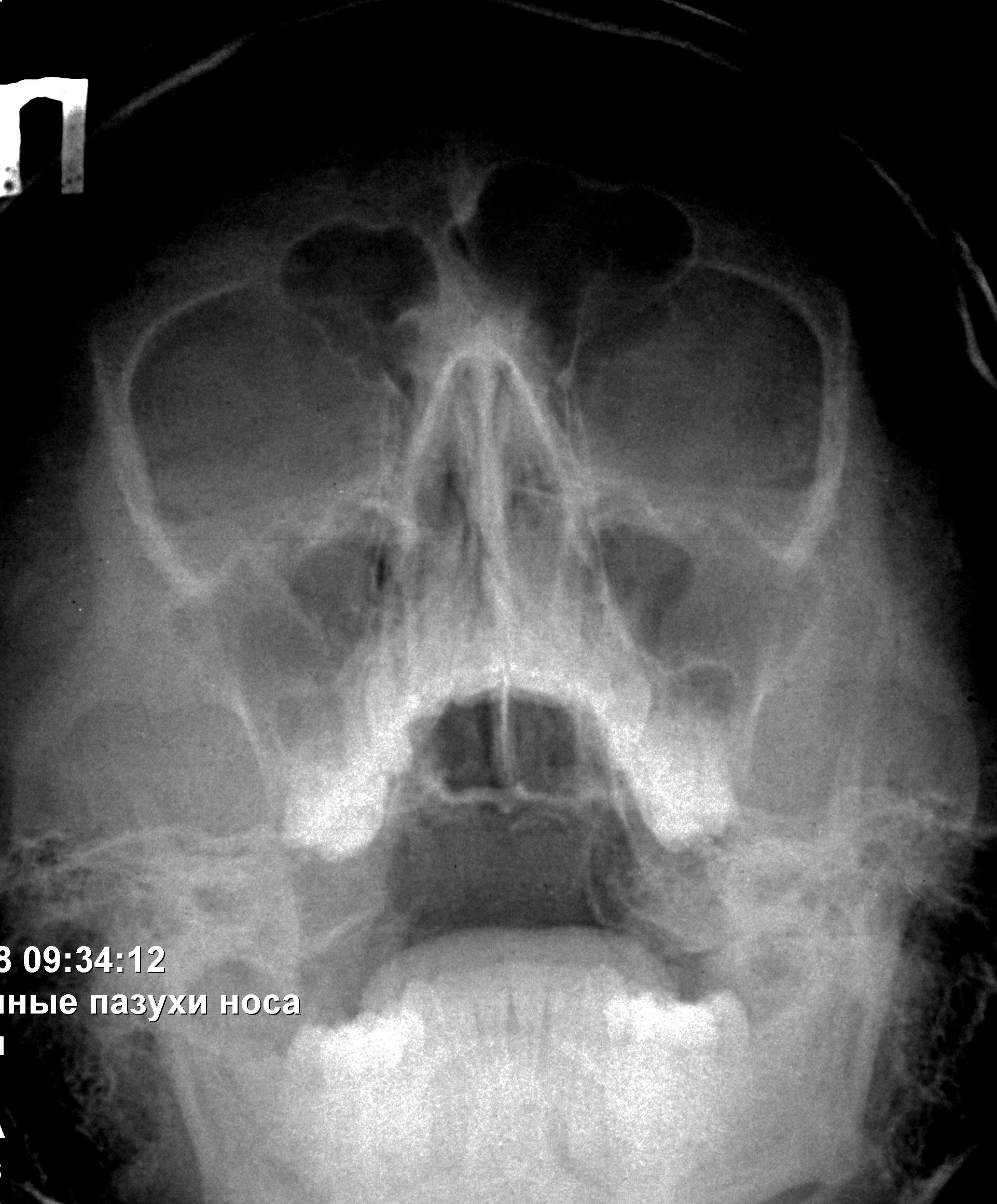 Рентген носовых пазух. Киста гайморовой пазухи на рентгене. Гипоплазия верхнечелюстной пазухи. Верхнечелюстная пазуха рентген анатомия. Гипоплазия верхнечелюстной пазухи рентген.
