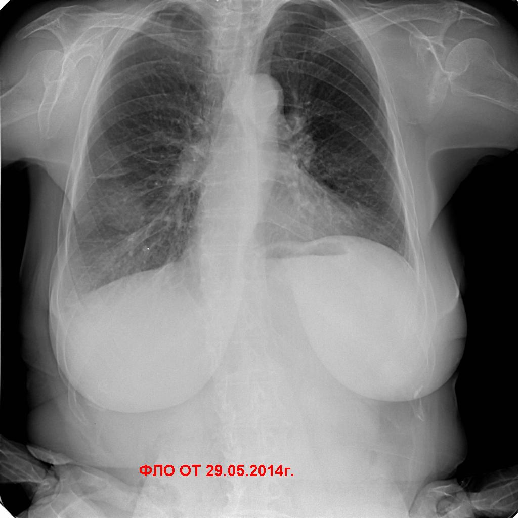 R графия. Флюорограмма в двух проекциях. Флюорография проекции. Флюорография легких проекции. Флюорография боковая проекция.