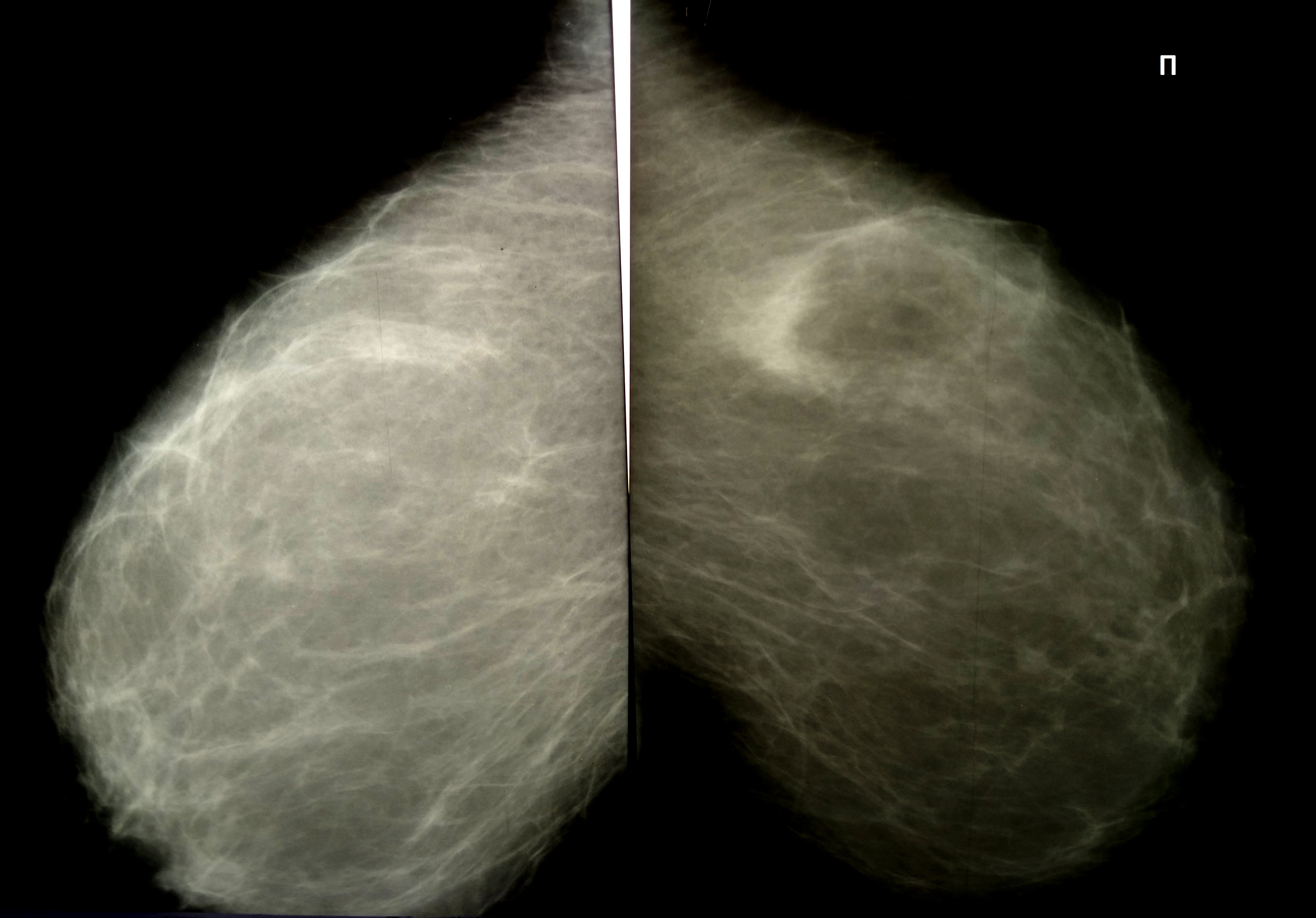 Маммограмма норма рентген