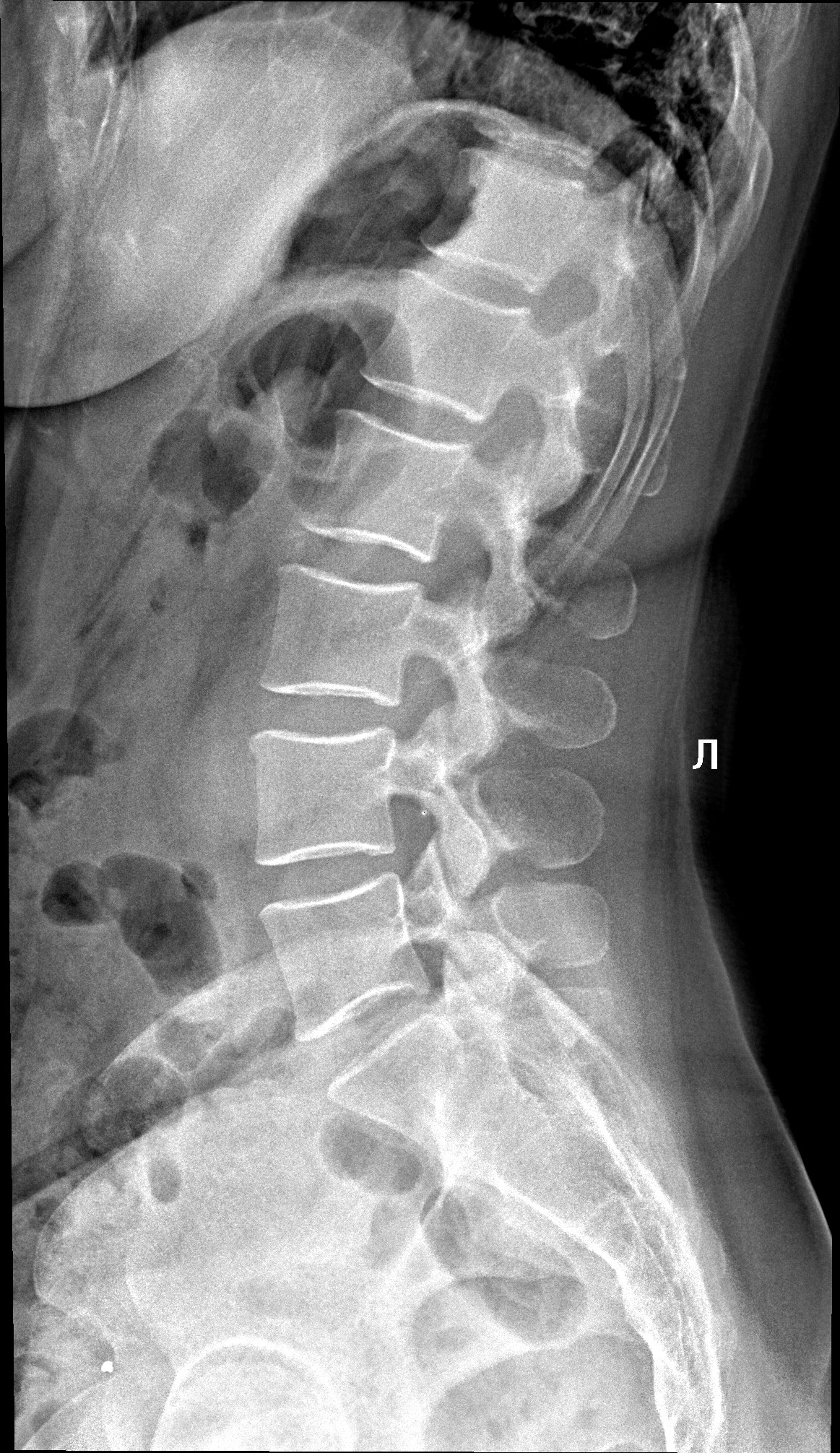 Рентген поясничного отдела фото