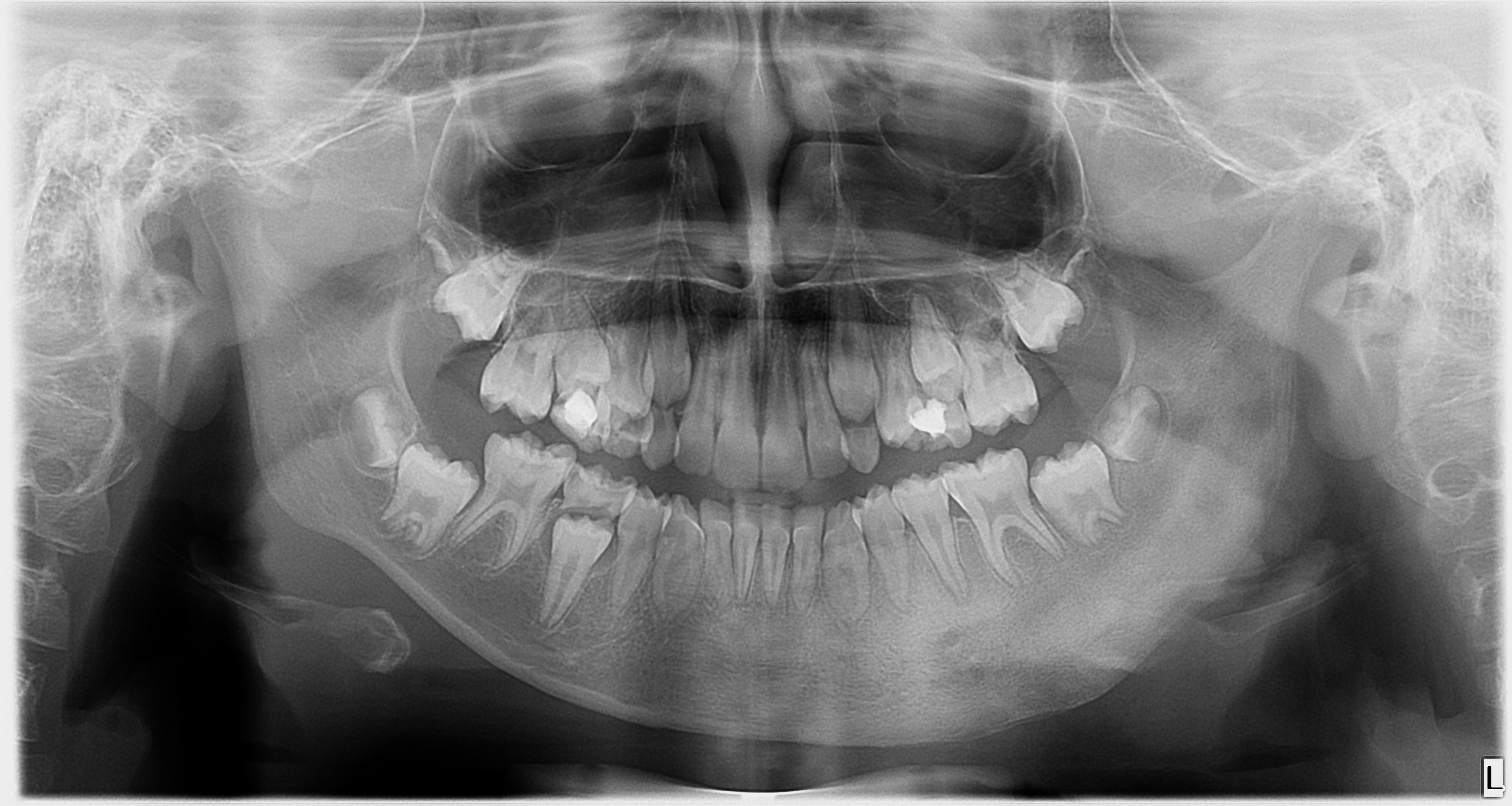 Детский рентген. Фиброзная дисплазия челюсти рентген. Ортопантомограмма перелом челюсти. Ортопантомограмма сменного прикуса.