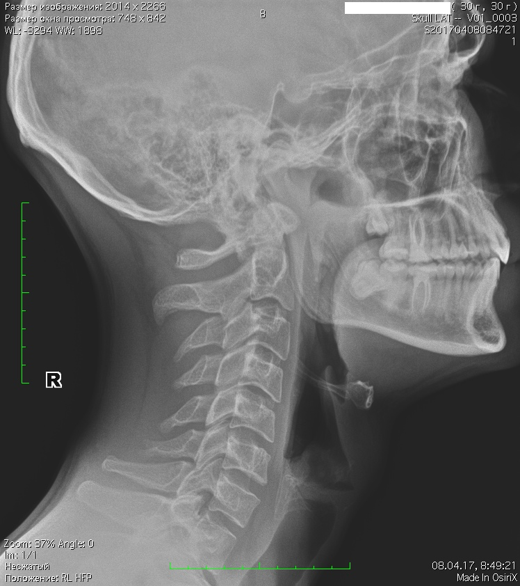 Кость в горле ненужная невеста читать. Перелом подъязычной кости рентген. Подъязычная кость перелом. Рентгенография гортани.