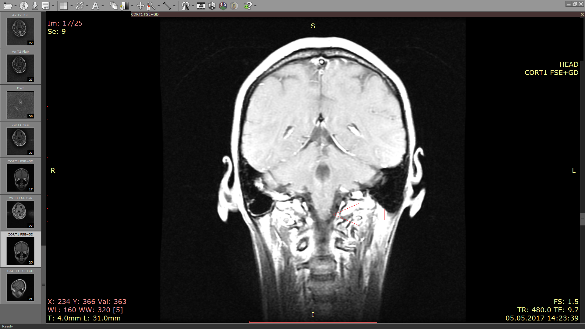 Рак ствола головного мозга. Астроцитома ствол мрт. Ствол головного мозга томограмма. Ствол головного мозга мрт. Ствол мозга на кт.