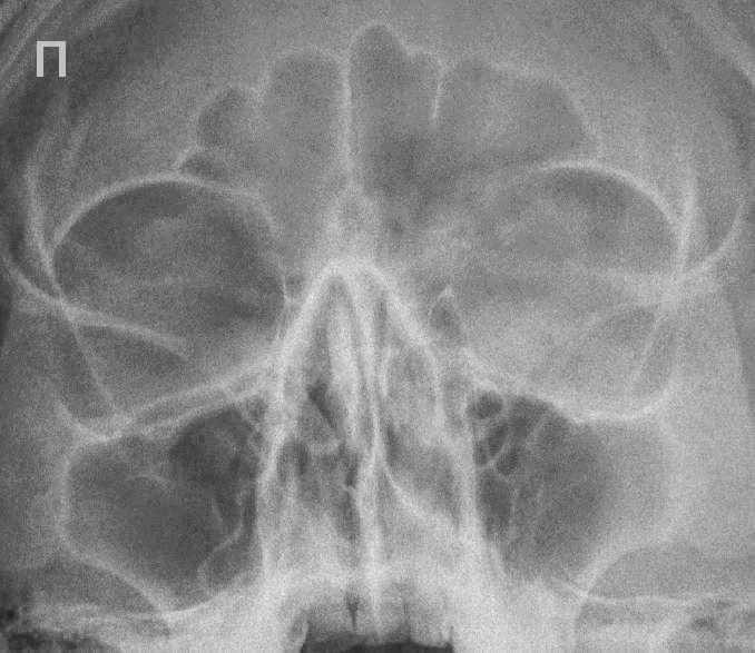 Неравномерное утолщение слизистой оболочки. Острый синусит фото рентген. Фото рентгена лобового синусита Гнойного.