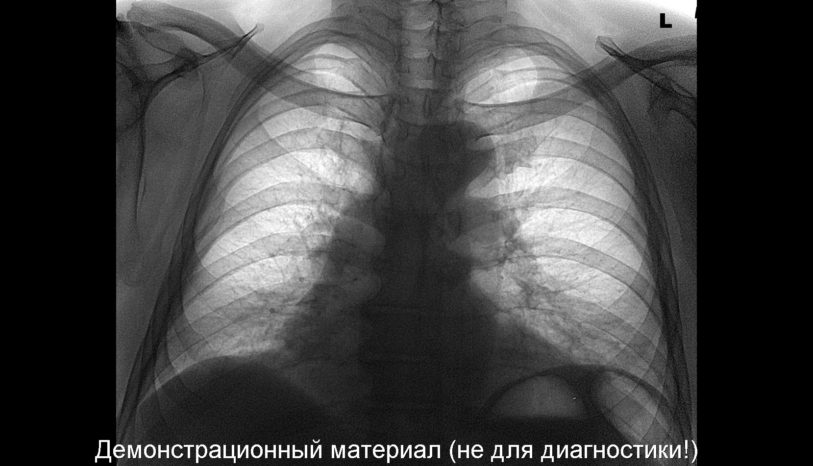 Аорта уплотнена. Праволежащая аорта на рентгене. Выпуклая дуга аорты на рентгенограмме. 2 Дуга на рентгенограмме. Тень главного бронха аорты.