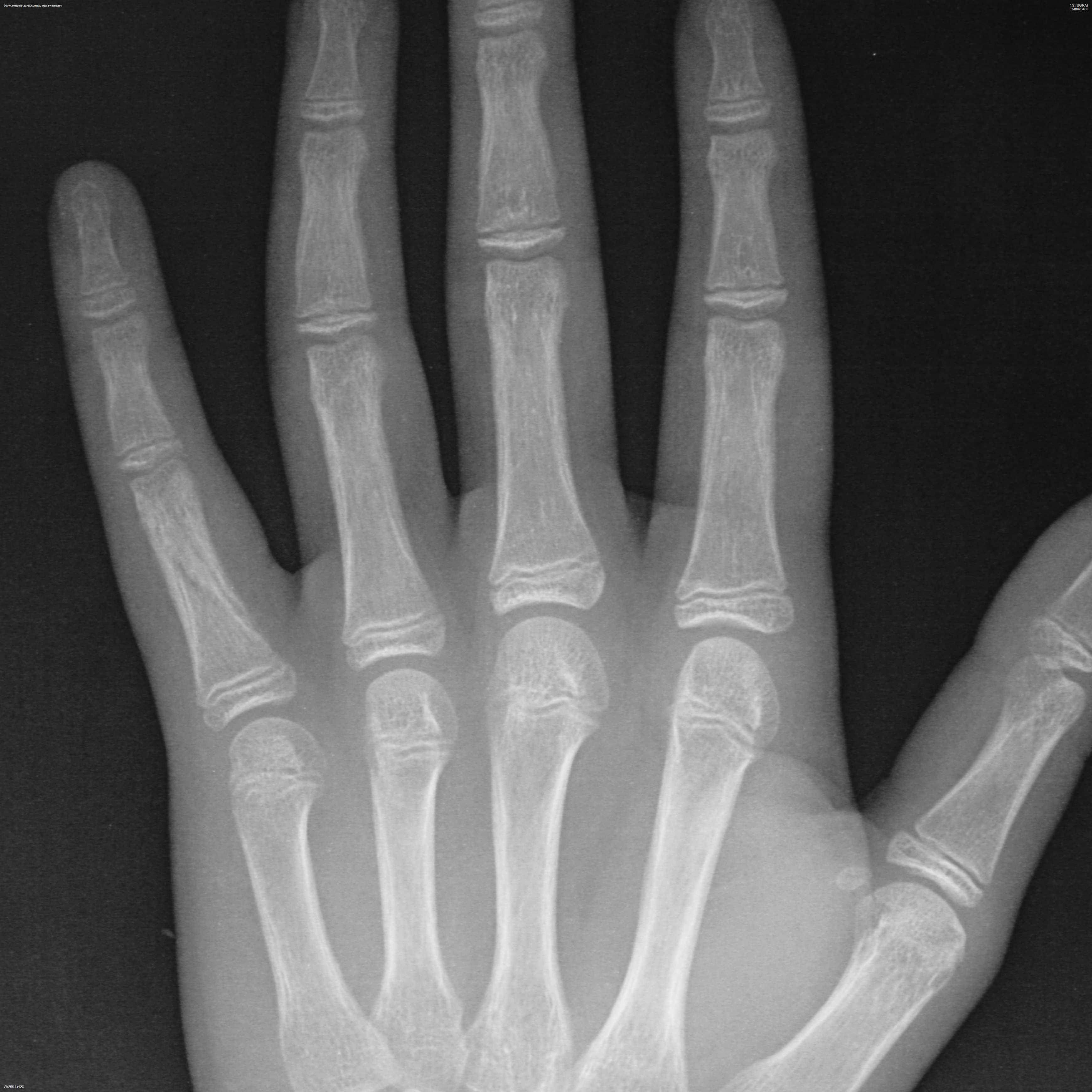 Перелом фаланги пальца на руке фото