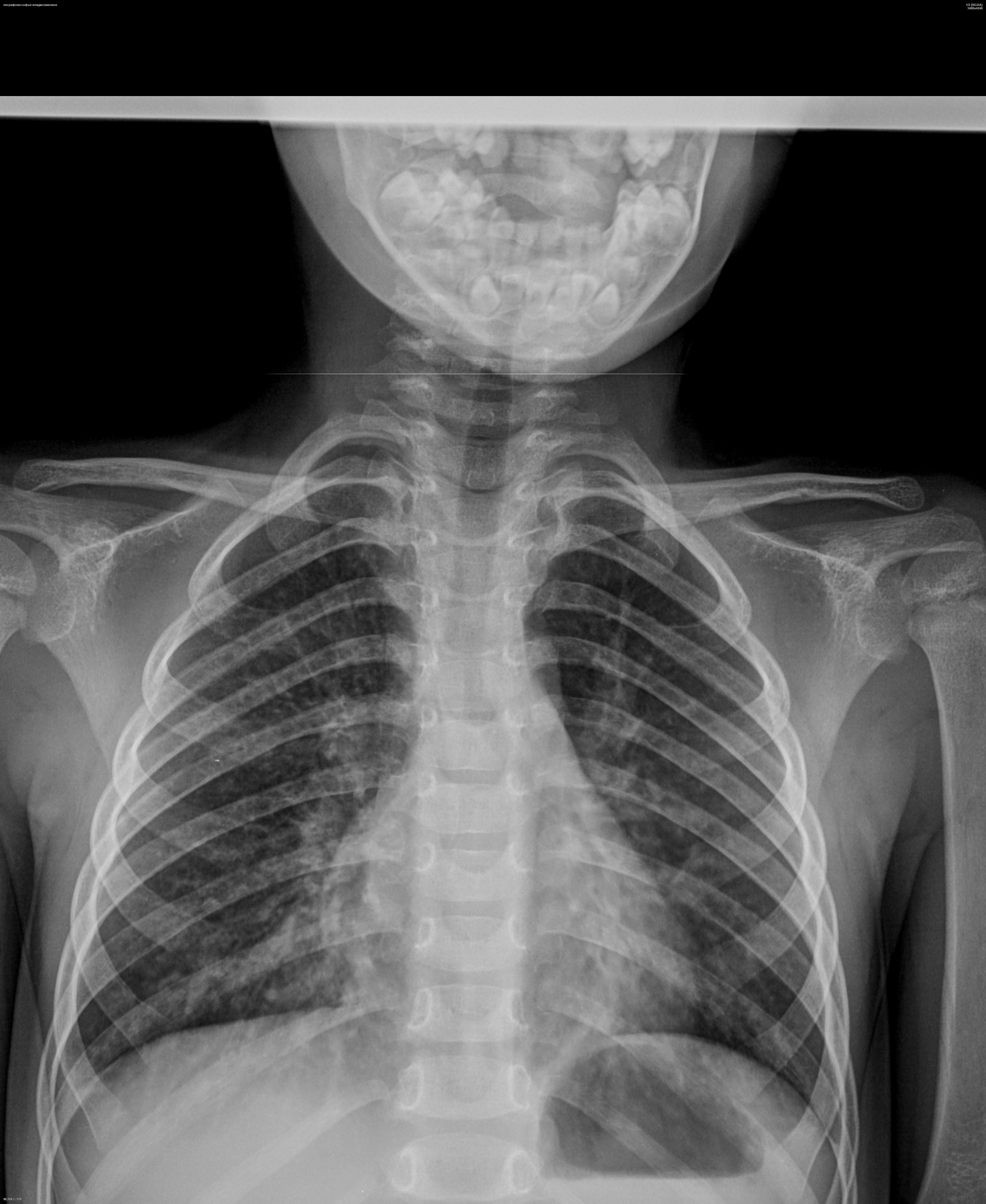 Аденопатия. Рентген ОГК дети. ОГК 3 месячного ребенка рентген. Холодноплазменная аденопатия. ПВА аденопатия справа неясной.