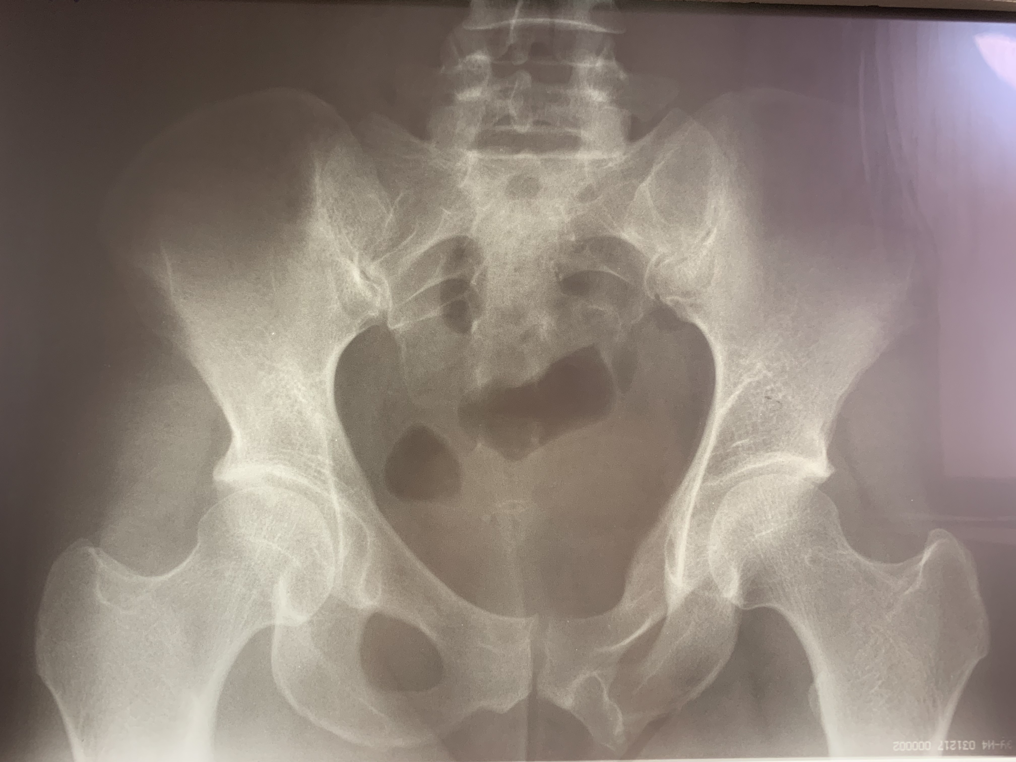 Перелом лонной кости рентген