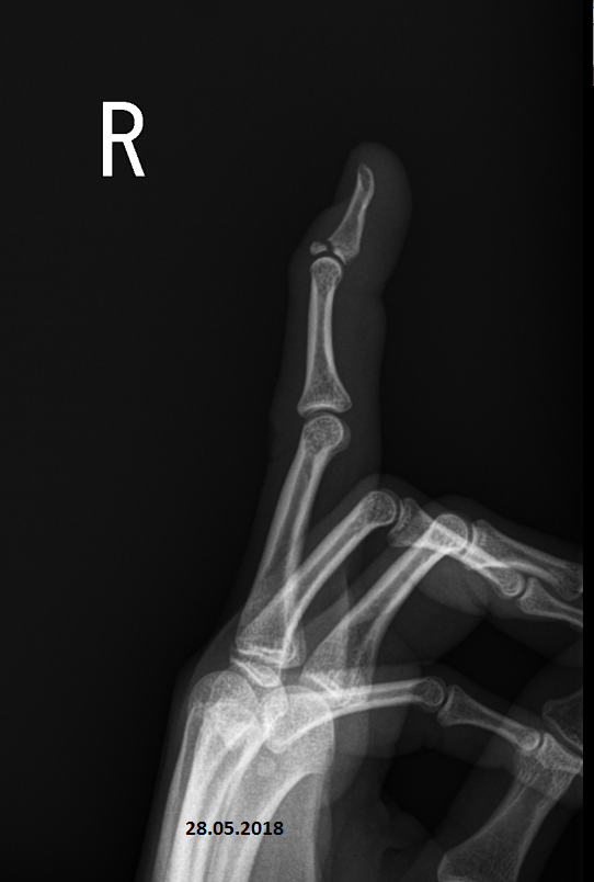 Трещина фаланги. Перелом дистальной фаланги кисти рентген. Краевой перелом фаланги рентген. Рентген перелома средней, фаланги мизинца руки. Перелом ногтевой фаланги кисти рентген.