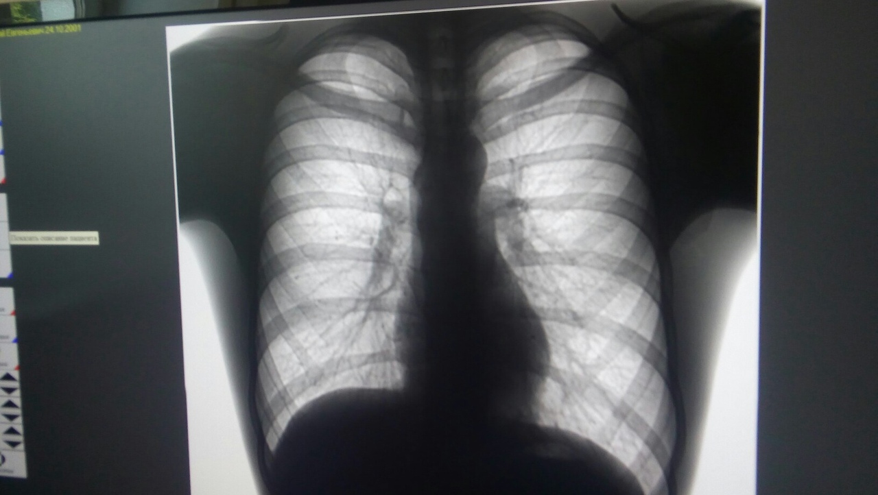 Снимок здоровых легких у человека на рентгене фото