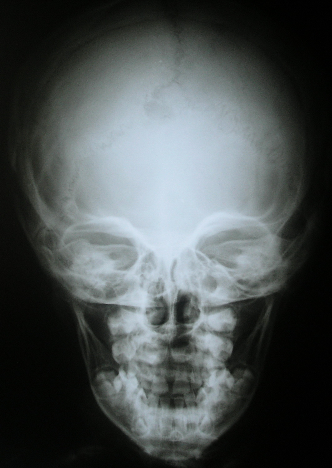 Детский череп рентген. Ахондроплазия рентген черепа. Рентгенография черепа ребенка. Рентген черепа новорожденного.