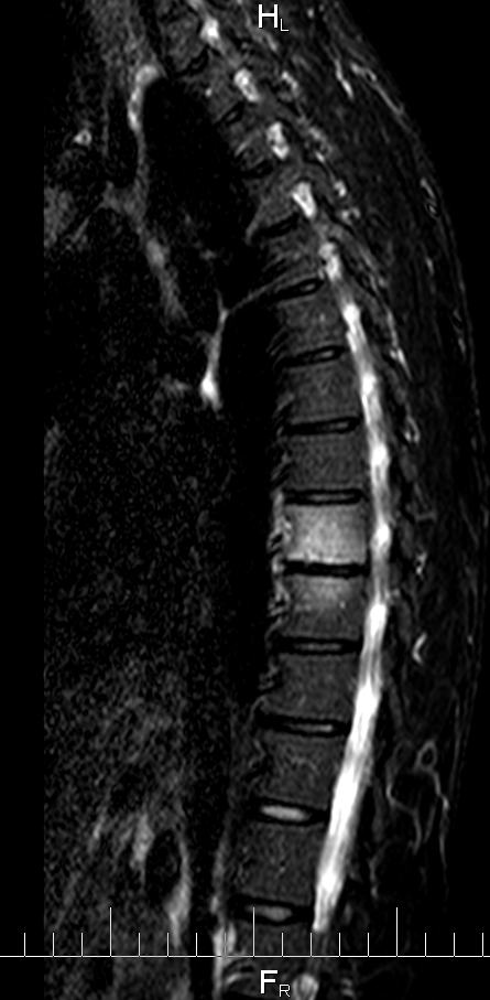 Спондилодисцит. Туберкулезный спондилодисцит мрт. Спондилодисцит с5 с6. Спондилодисцит поясничного отдела позвоночника на кт. Спондилодисцит позвоночника рентген.