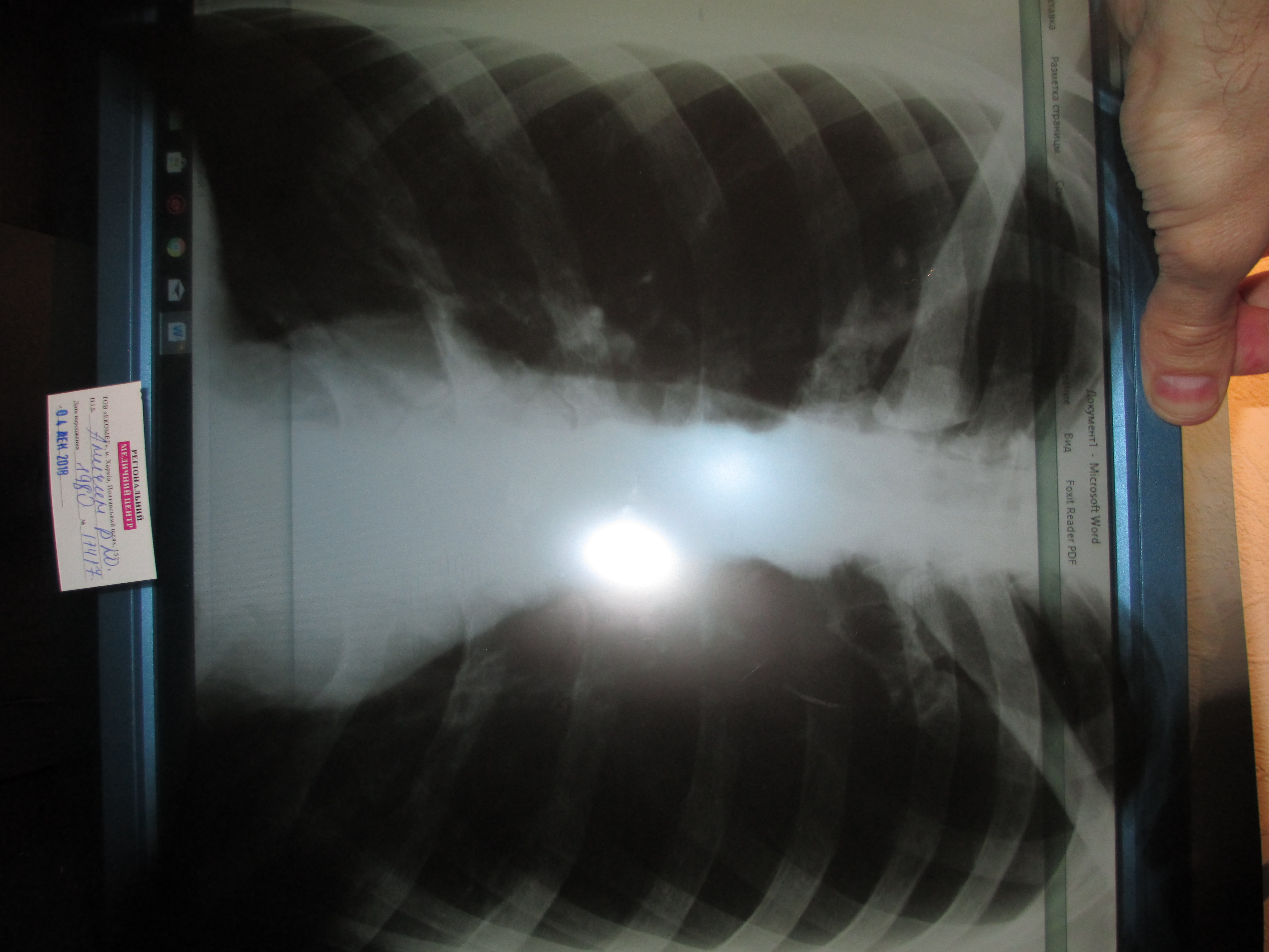 Перелом ребра рентген фото