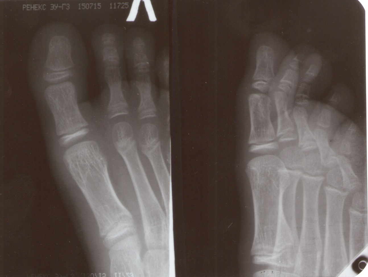 Ногтевая фаланга ноги. Оскольчатый перелом ногтевой фаланги рентген. Перелом ногтевой фаланги мизинца. Краевой перелом проксимальной фаланги 1 пальца стопы рентген. Краевой перелом ногтевой фаланги рентген.