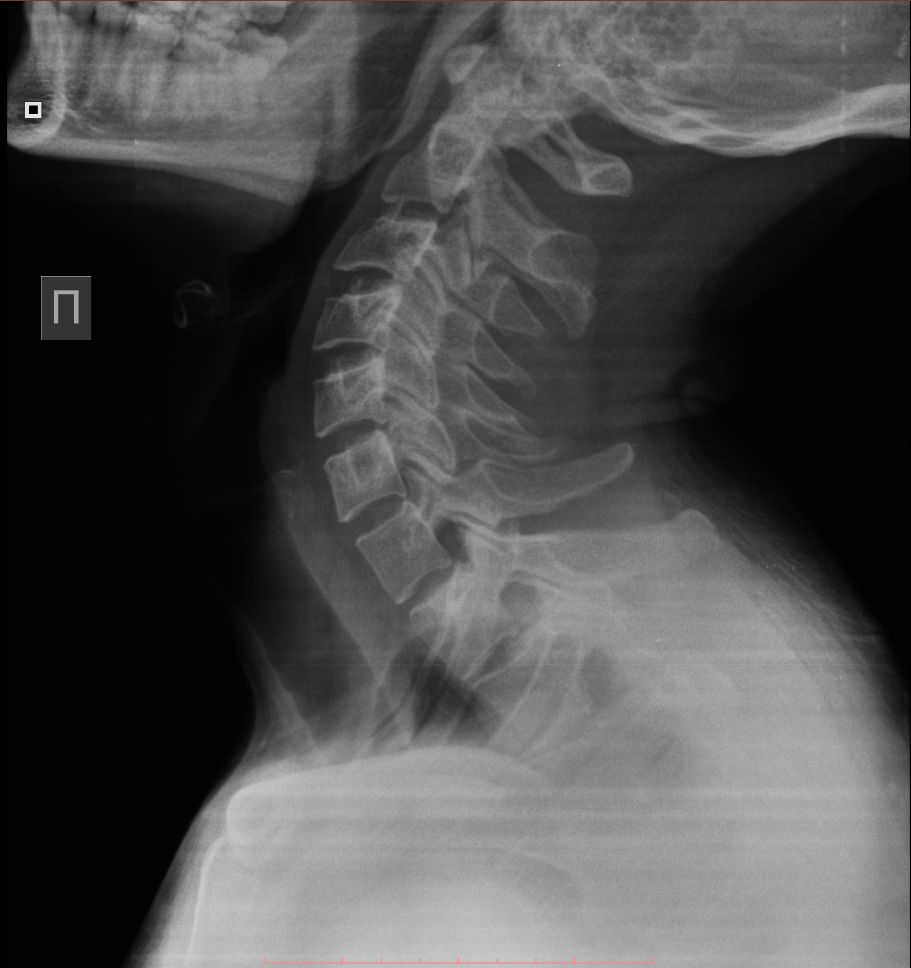 Рентгенография шейного. Шоп рентген норма. Рентген шеи. Снимок шеи рентген. Рентген шеи здорового человека.