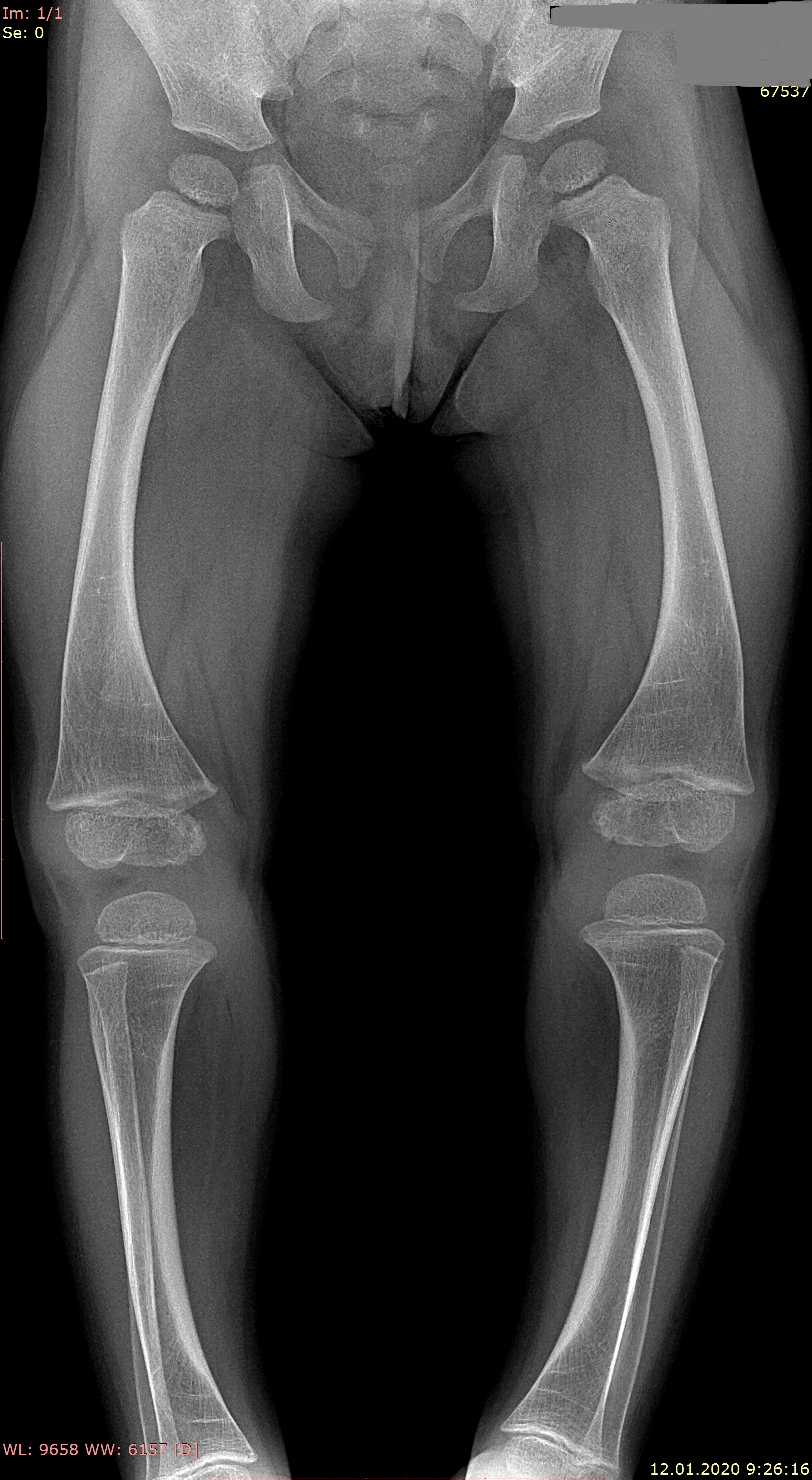 Вальгус коленных суставов рентген. Варусная деформация бедра рентген. Ваоуснея деформаяи колен. Варусная деформация колена рентген.
