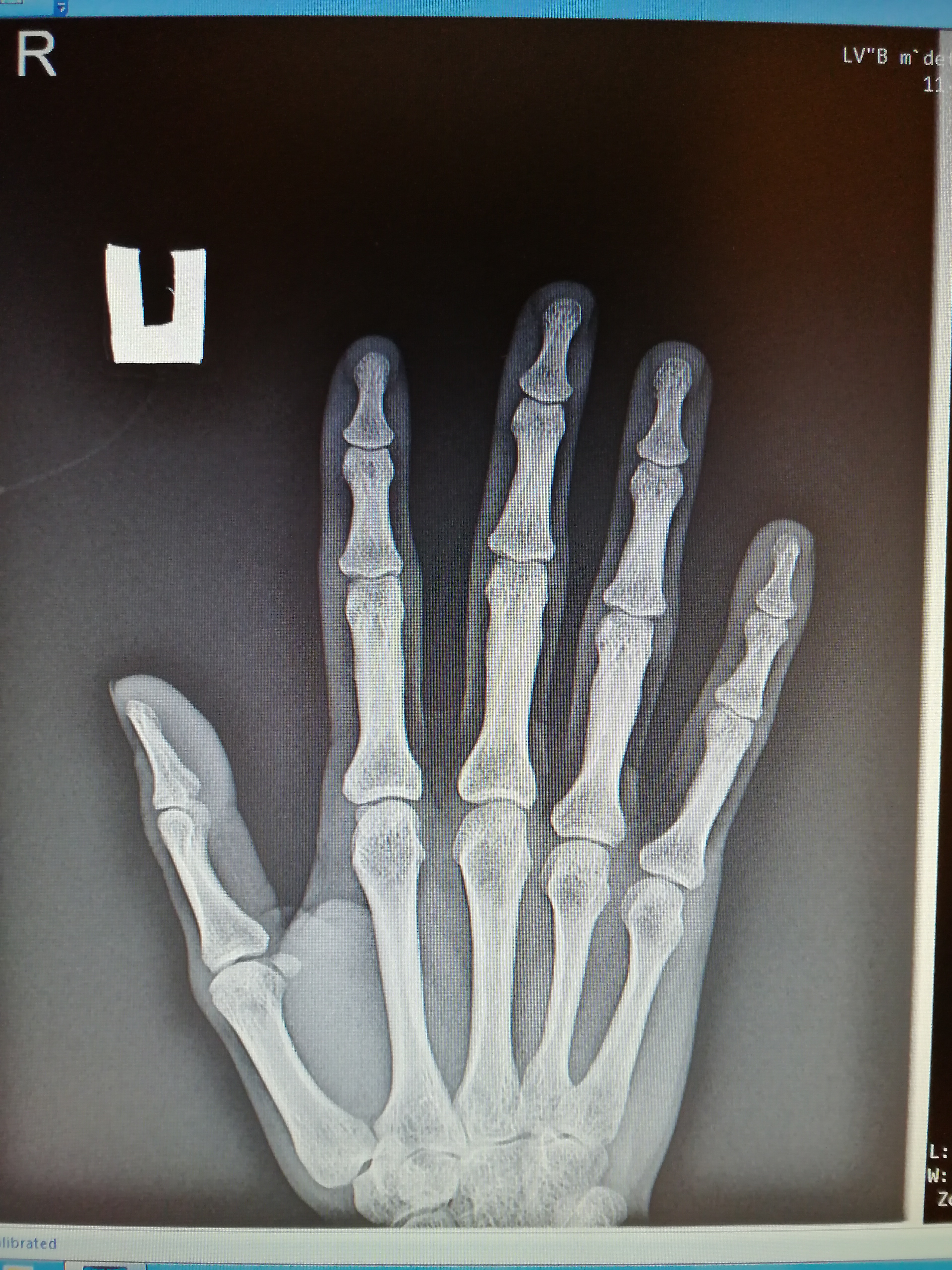 Перелом ногтевой фаланги 1 пальца