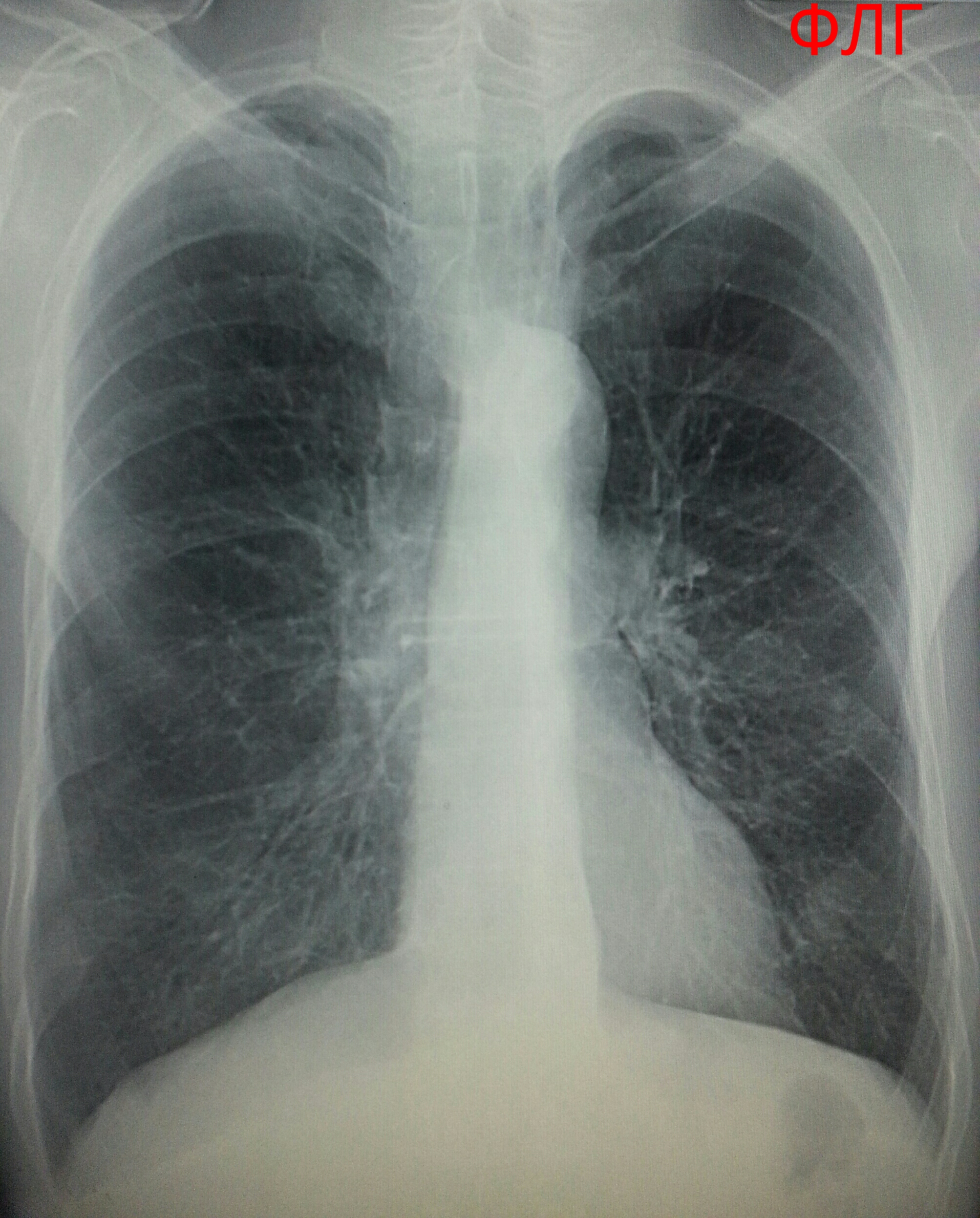 70 лет в железном легком. Рентген ОГК пневмония. Мокрота в легких на рентгене.