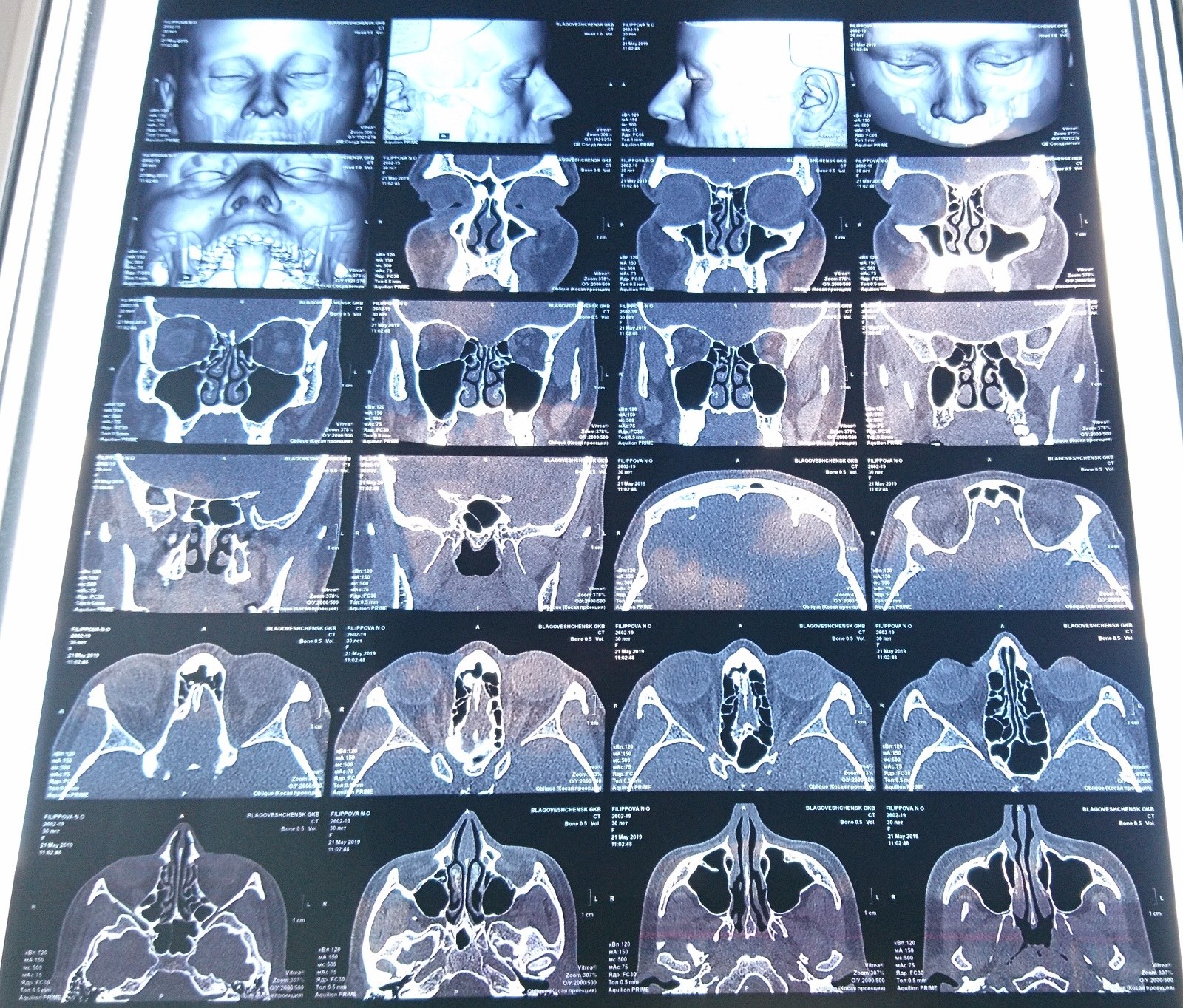 Кт пазух носа. Мрт околоносовых пазух. 3д кт придаточных пазух носа. Мрт придаточных пазух носа.