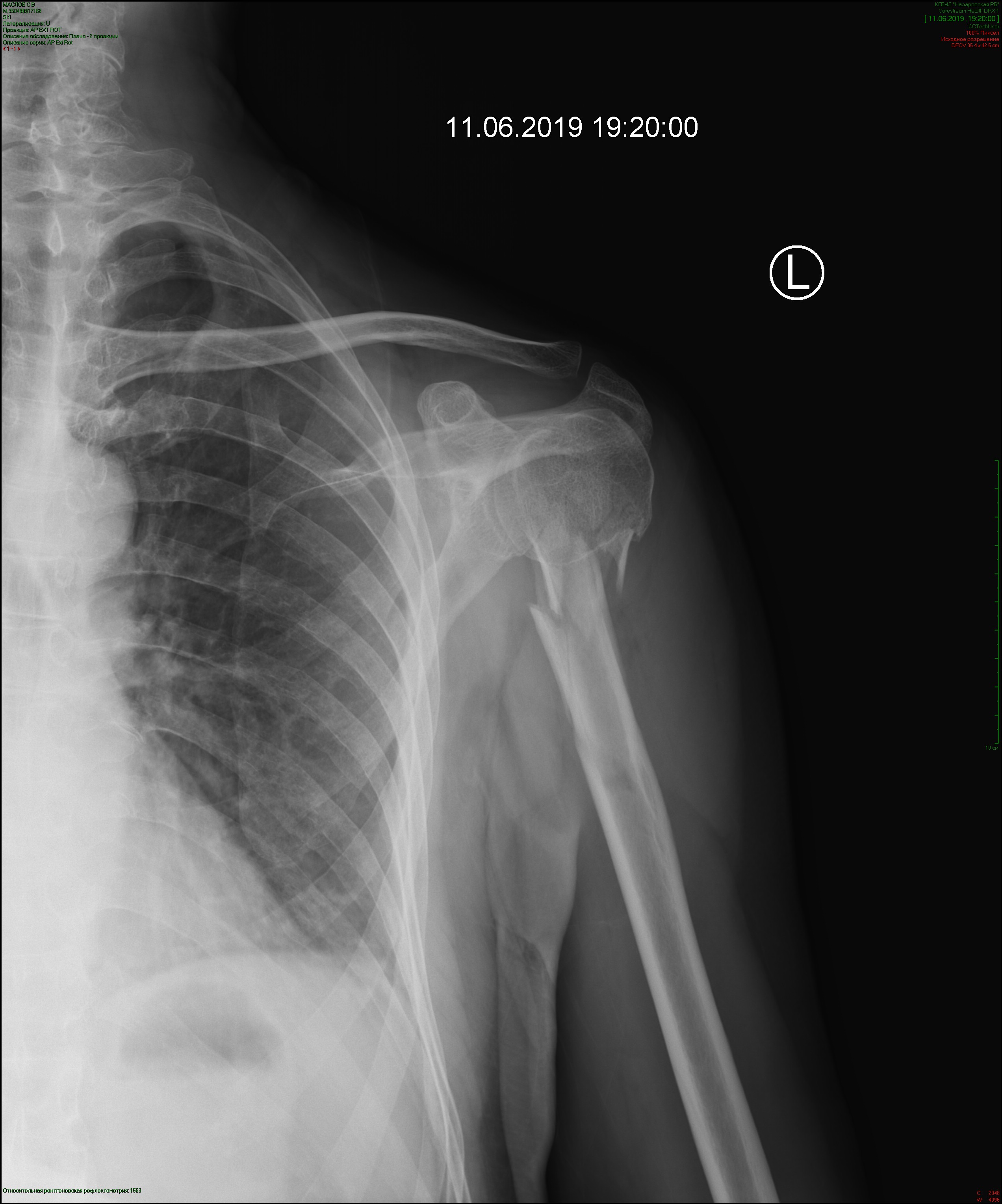 Перелом большого бугра плечевой кости без смещения рентген