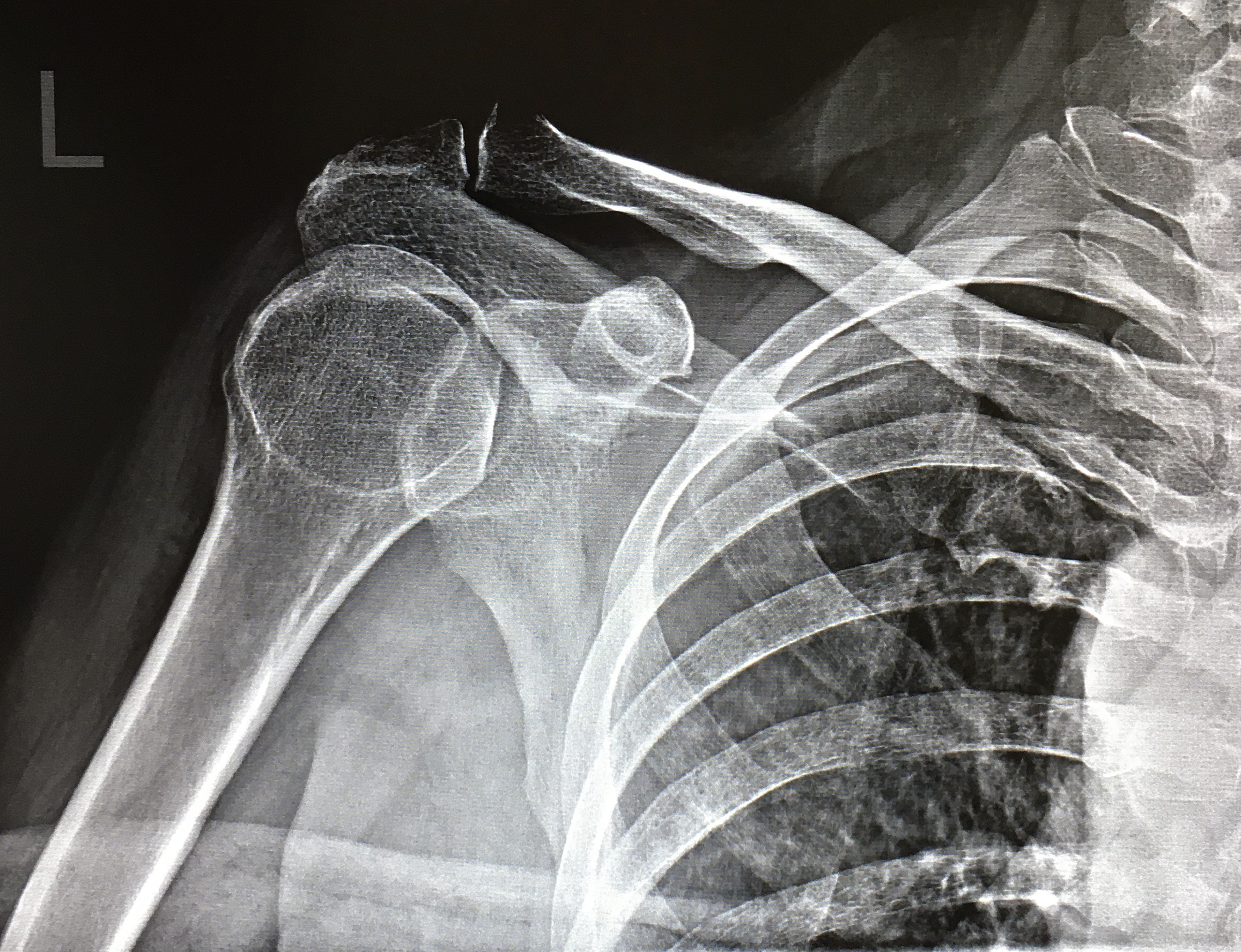 Снимок. Подвывих плечевого сустава рентген. Задний подвывих плечевого сустава рентген. Плечевой сустав рентген норма. Лигаментоз плечевого сустава рентген.