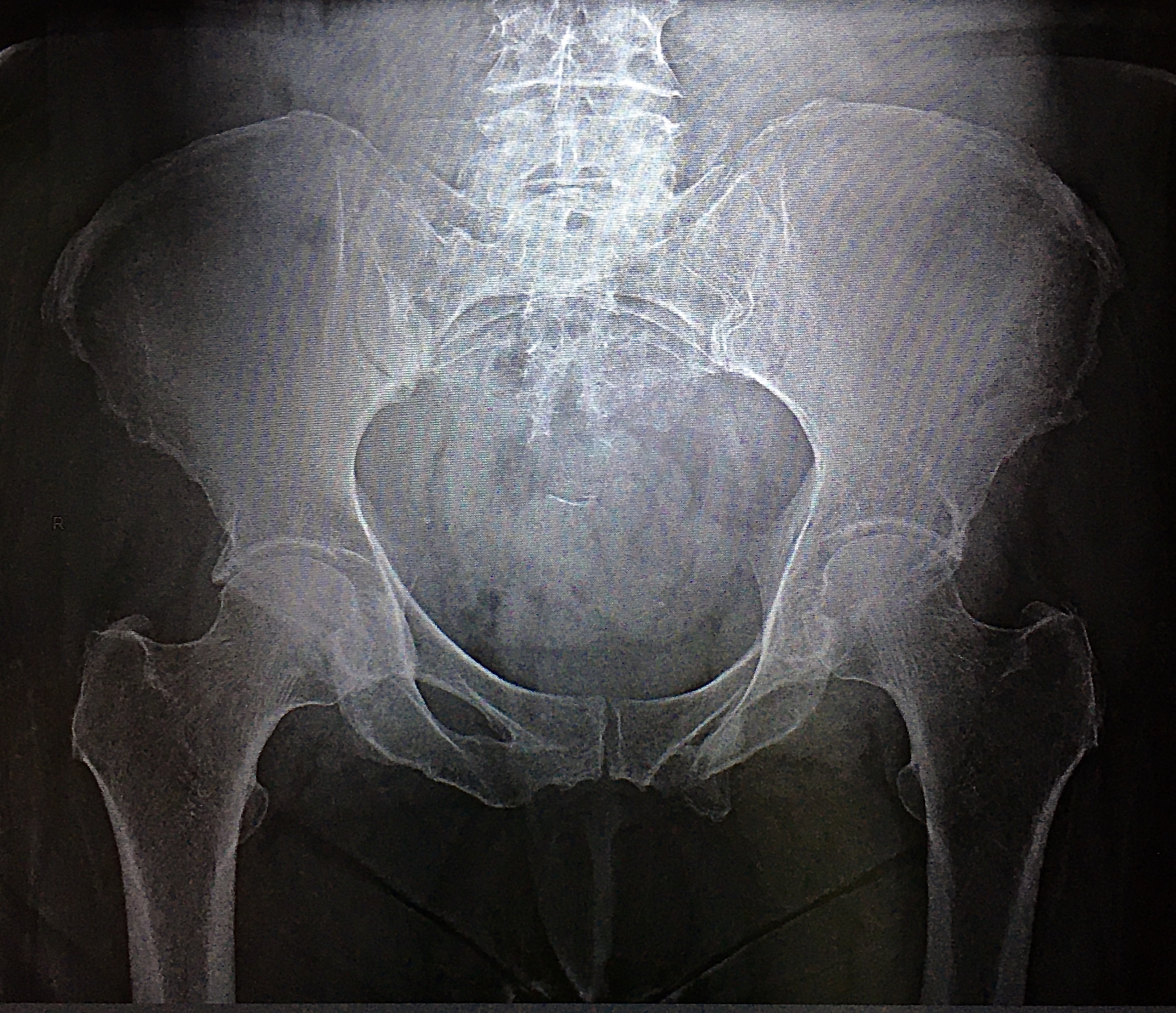 Трещина крестца. Зоны роста лонных костей. Перелом крыла крестца справа. Артроз лонного сочленения рентген.