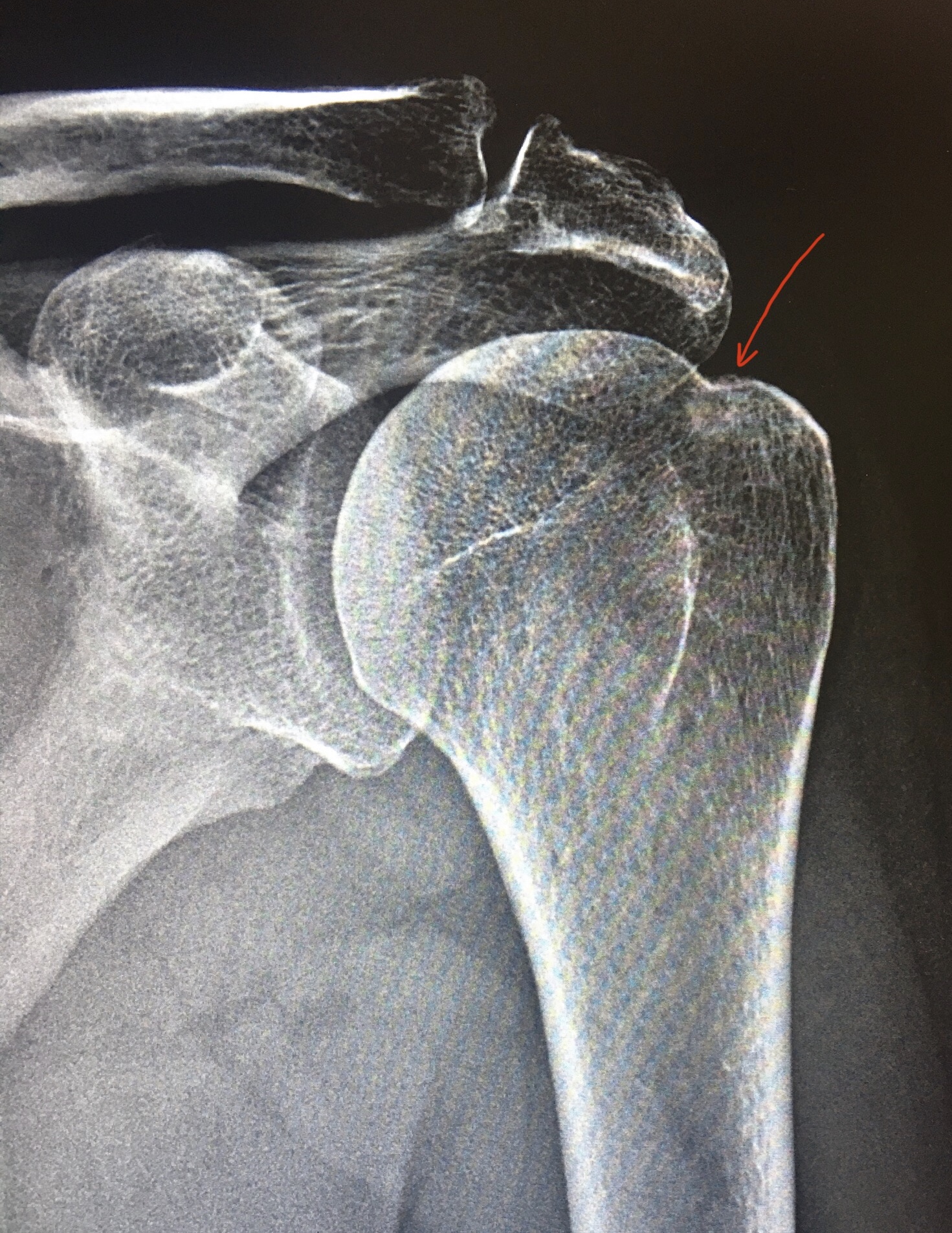 Большой бугорок плечевой кости. Большой бугорок головки плечевой кости. Эрозия большого бугорка плечевой кости. Разъедание большого бугорка плечевой кости на рентгене.