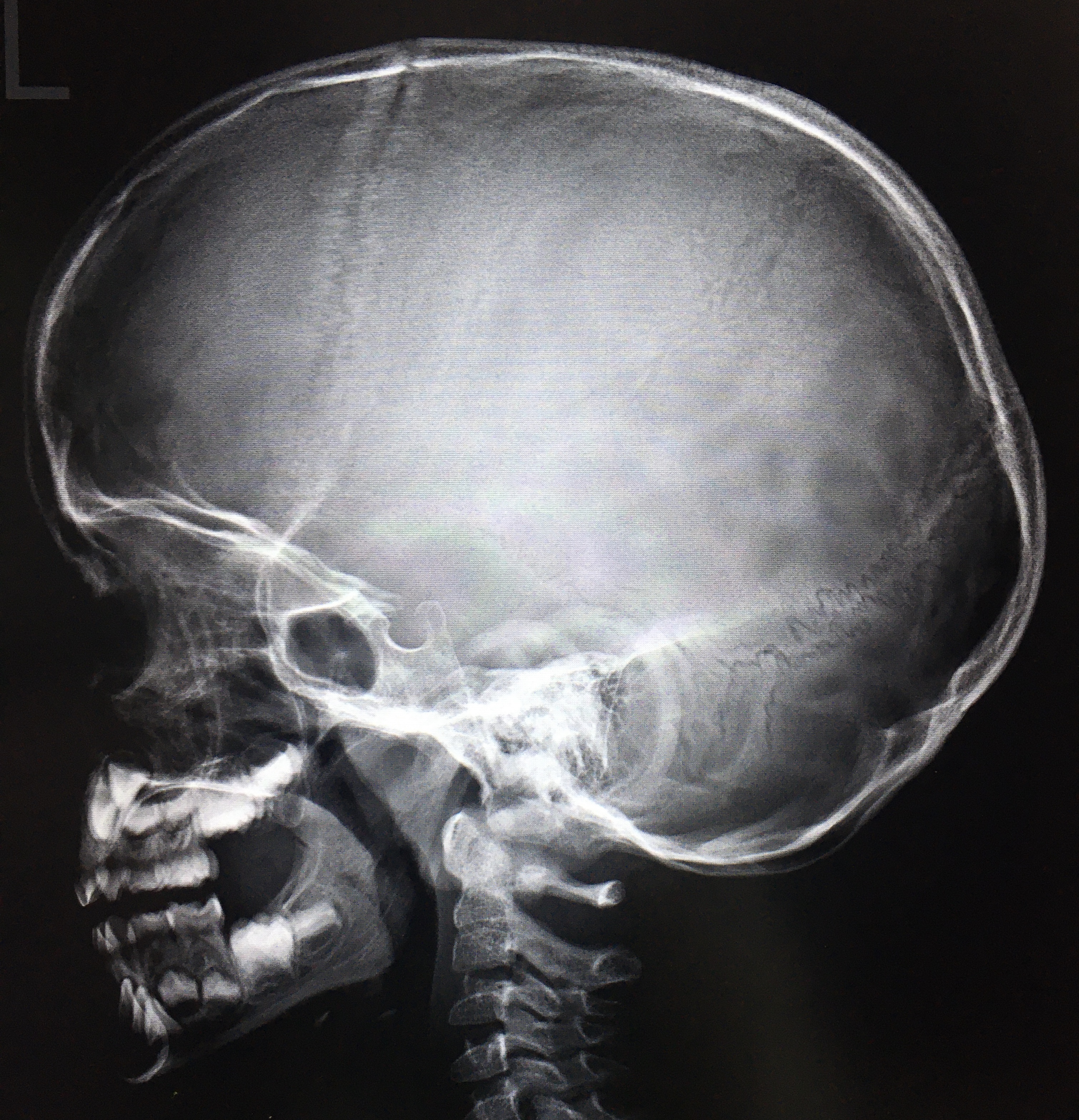 Снимок. Рентген черепа менингит.