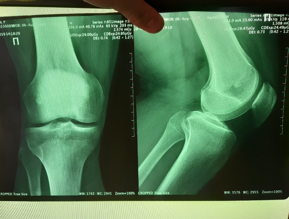 Рентген коленного сустава фото как делают