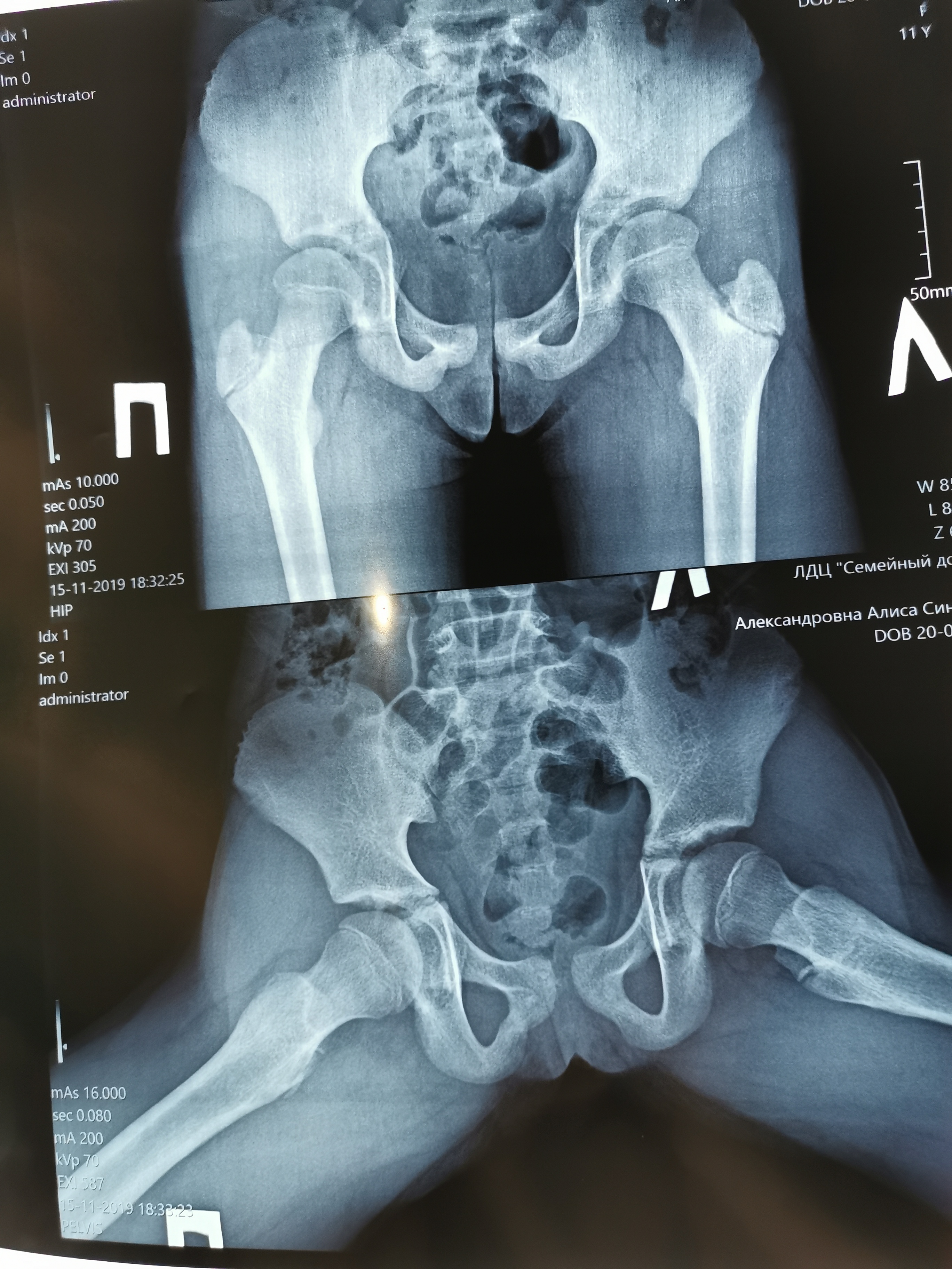Дисплазия тазобедренных суставов у взрослых рентген