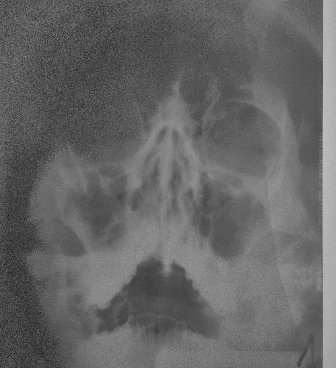 Рентген носовых пазух. Хондрома пазух носа рентген. Холестеатома околоносовых пазух.