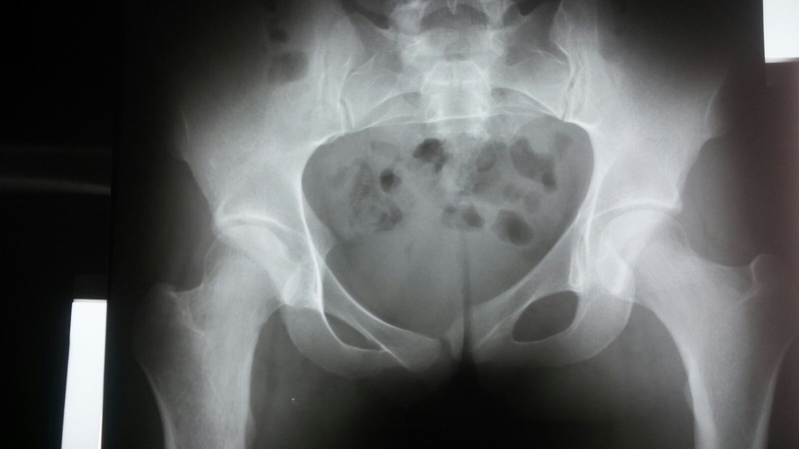 Метастазы в седалищной кости симптомы и признаки с фото