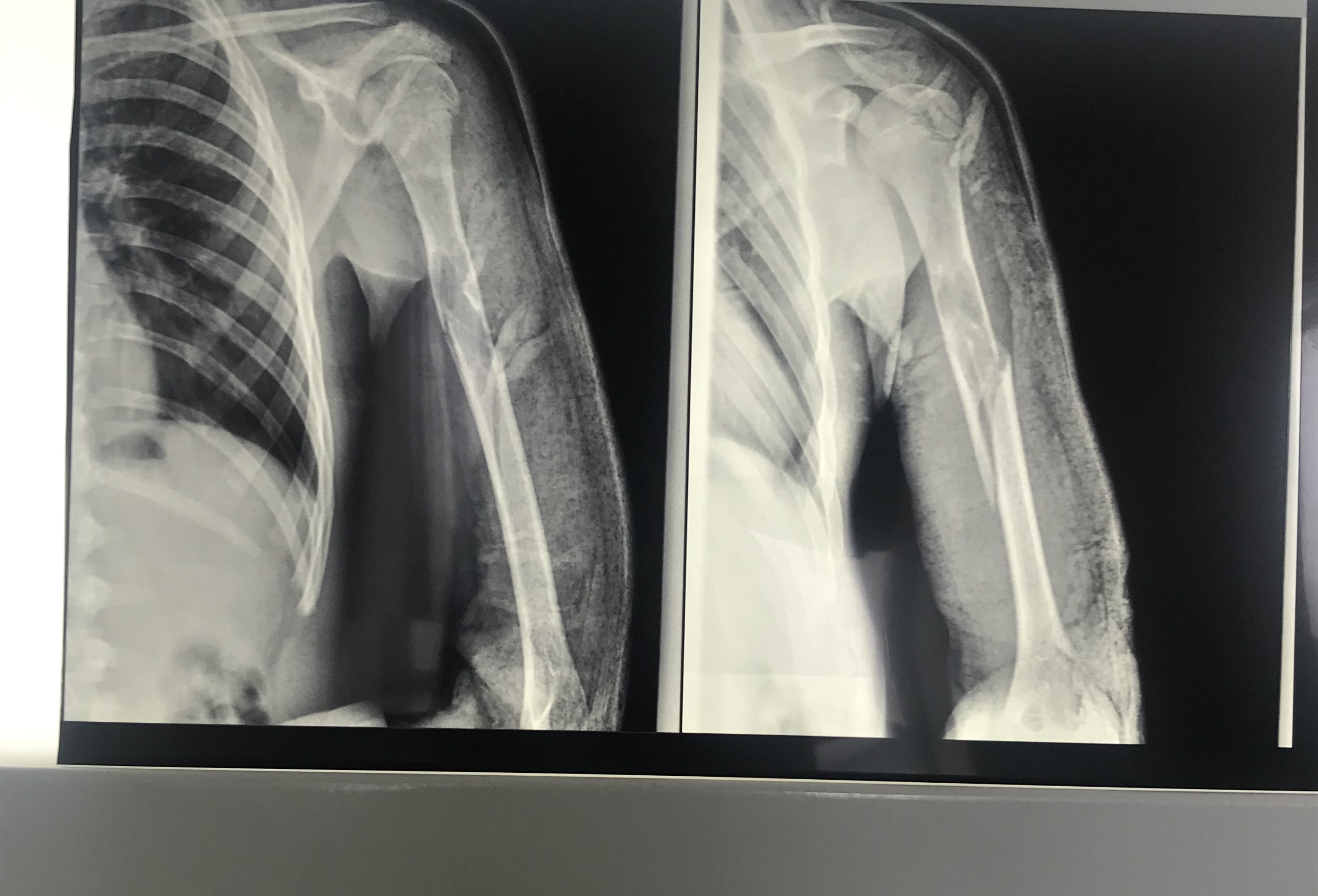 Снимок трещины. Винтообразный перелом плечевой кости рентген. Винтообразный перелом рентген. Перелом диафиза плечевой кости рентген. Винтообразный перелом плечевой кости.