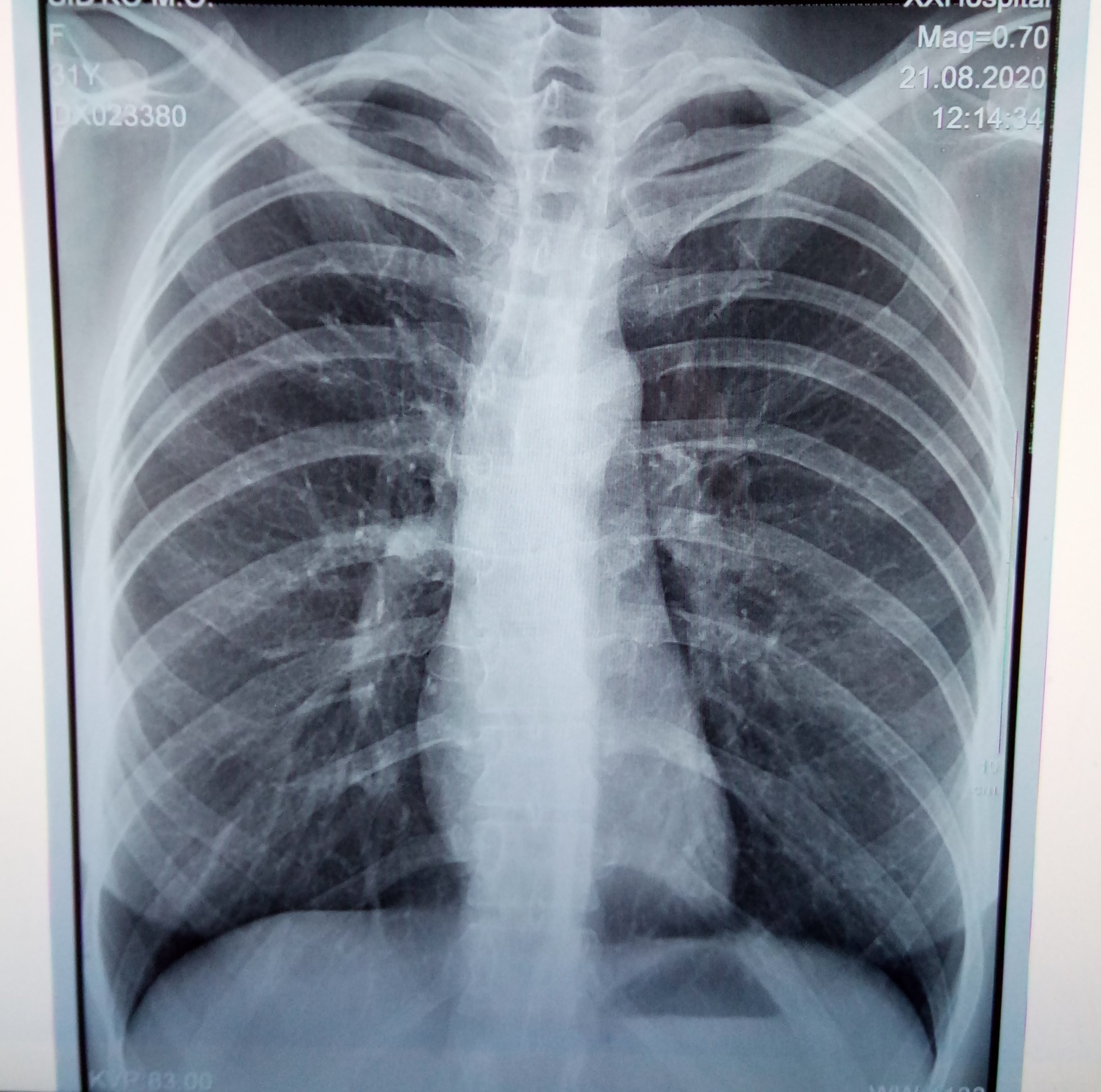 Фото здоровых легких на рентгене