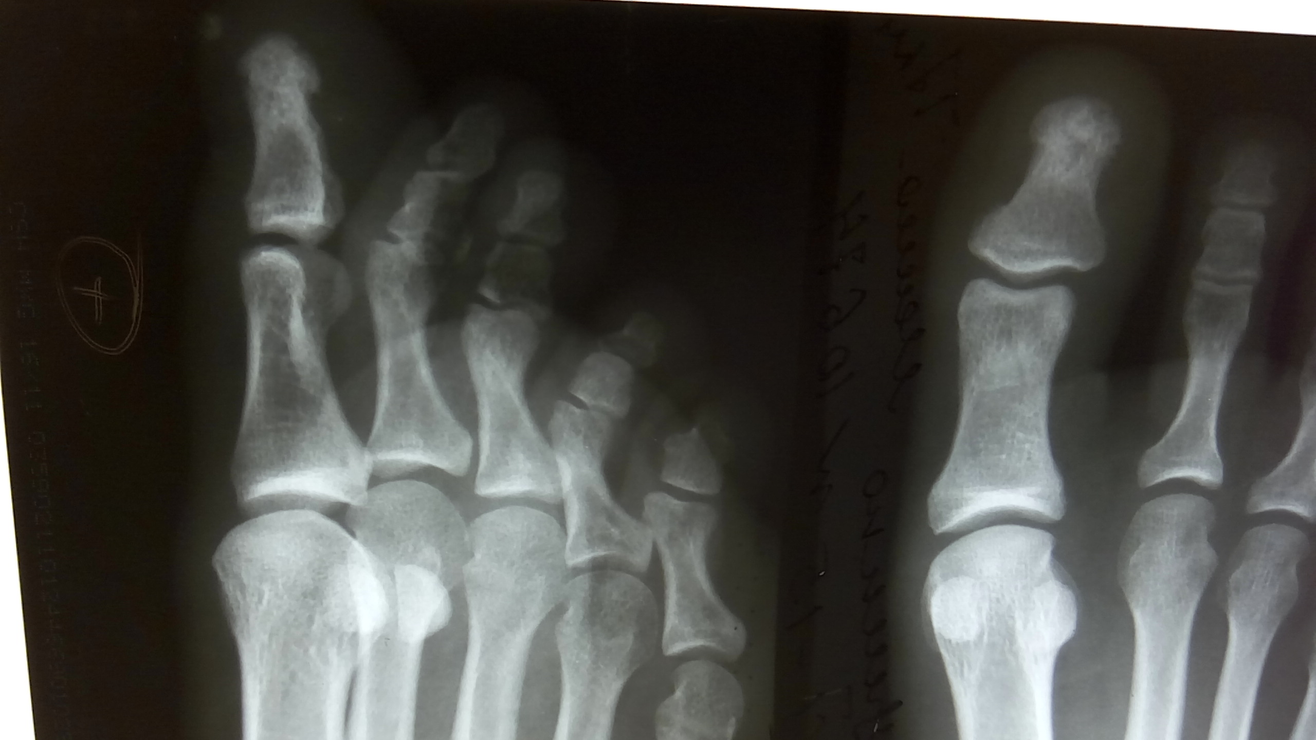 Ногтевая фаланга стопы. Экзостоз ногтевой фаланги 1 пальца стопы. Остеомиелит 1 пальца стопы рентген. Остеомиелит фаланг стопы рентген. Асептический некроз стопы рентген.