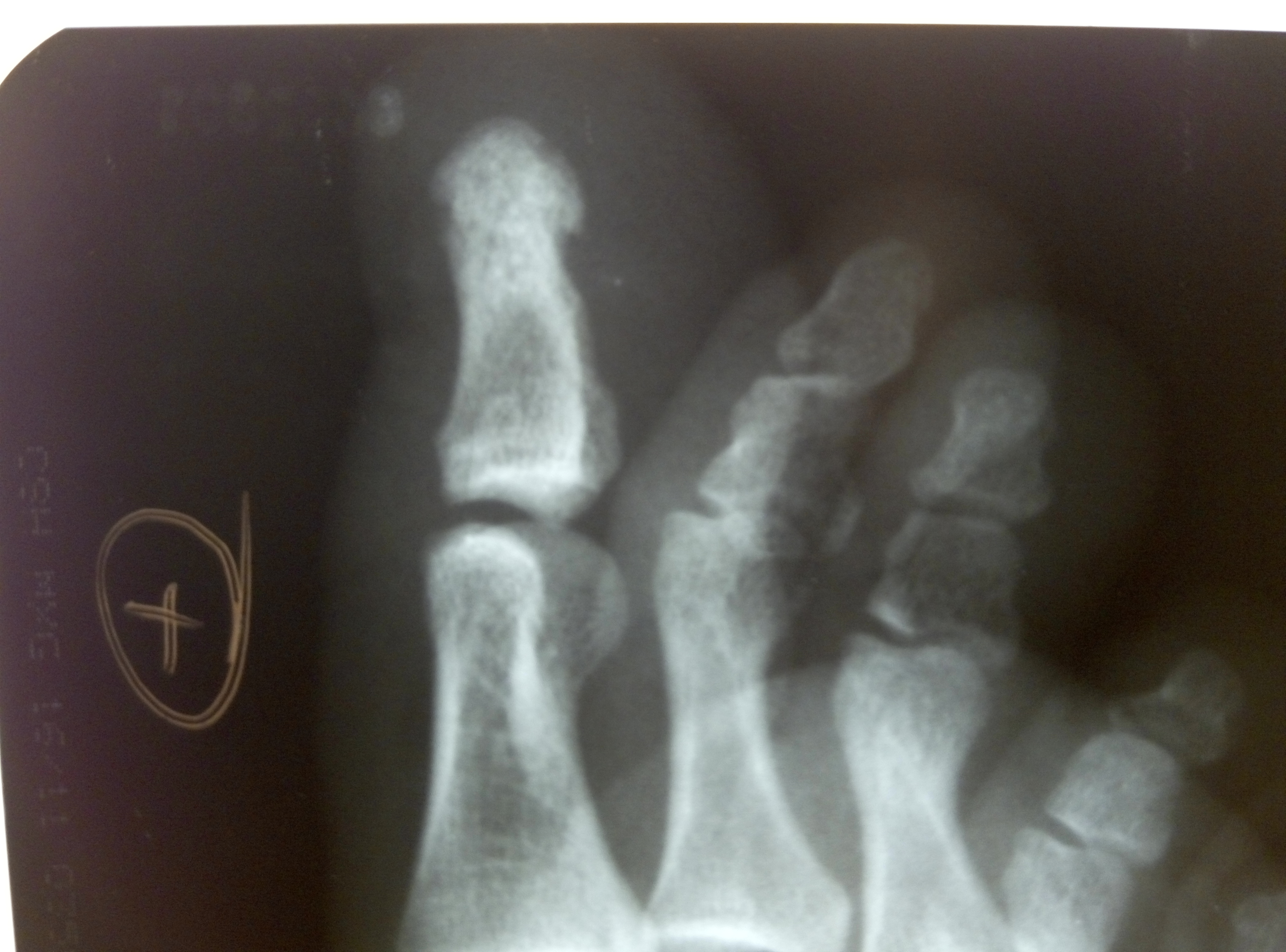 Ногтевая фаланга стопы. Остеомиелит пальца рентген. Остеомиелит фаланги большого пальца стопы рентген. Остеомиелит фаланг стопы рентген. Остеомиелит фаланги рентген.