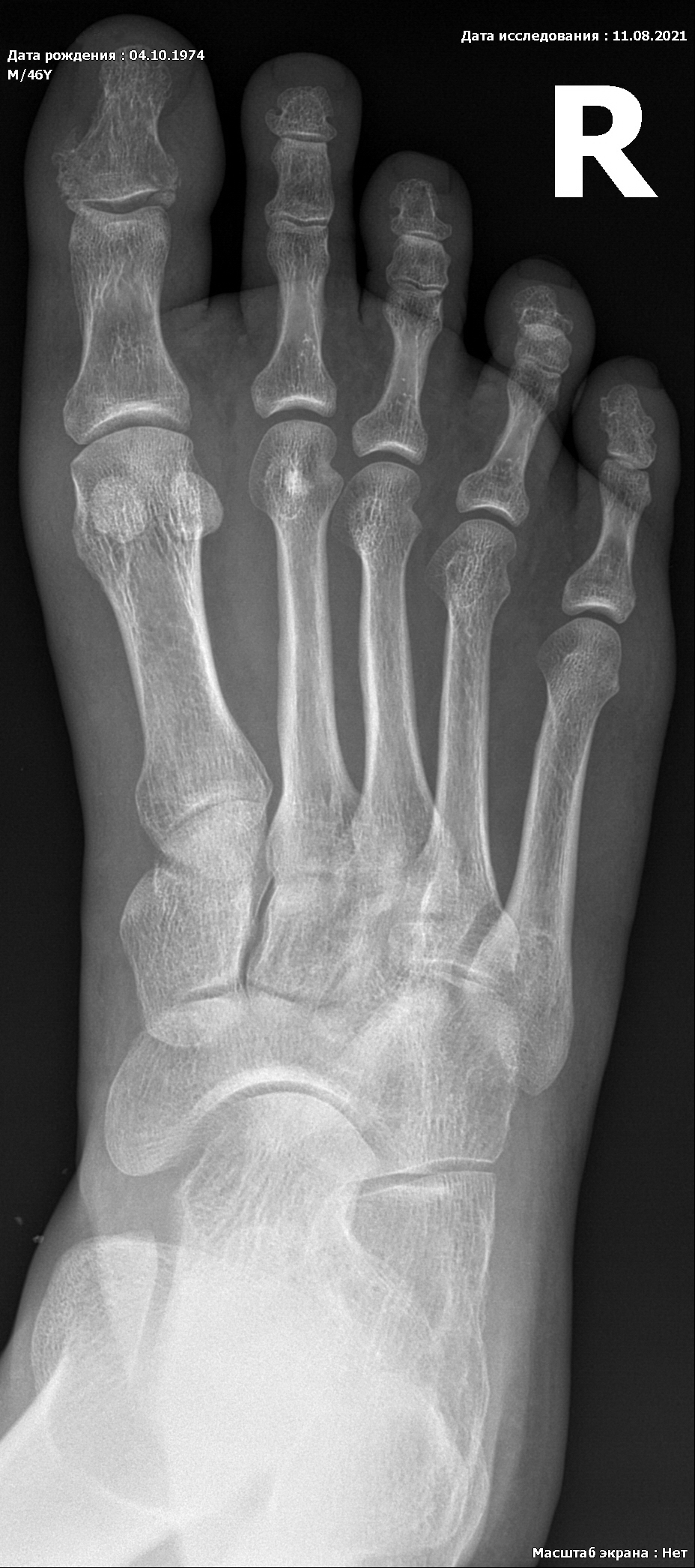 Ногтевой фаланги пальца ноги. Перелом ногтевой фаланги рентген. Внутрисуставной перелом фаланги пальца рентген. Внутрисуставной перелом пальца снимки. Перелом ногтевой фаланги 1 пальца стопы.