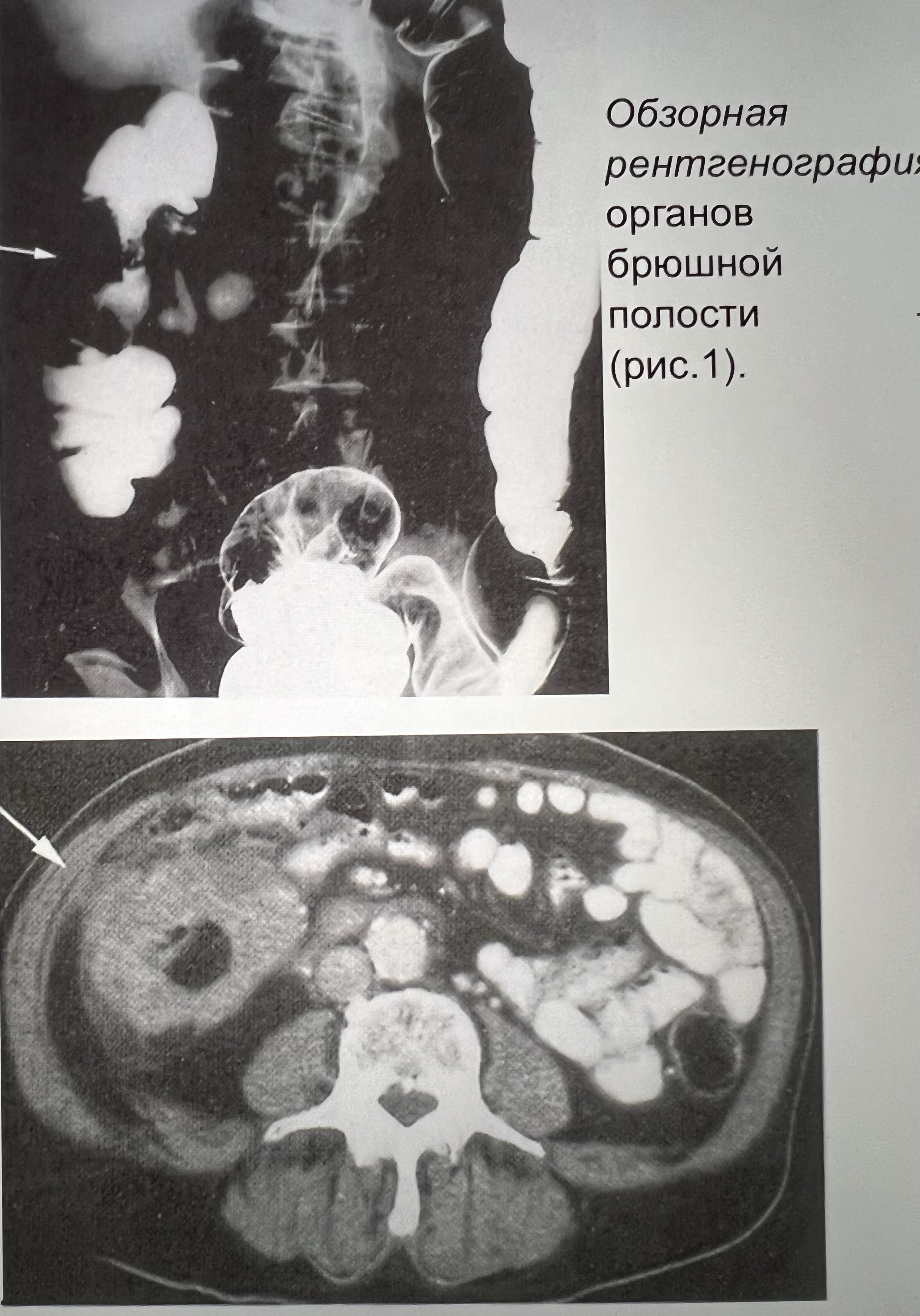 Кт органов брюшной полости. Протокол обзорной рентгенографии брюшной полости. Обзорный рентгеновский снимок брюшной полости аскариды. Кандидоз органов на кт. Учебники по кт органов брюшной полости.
