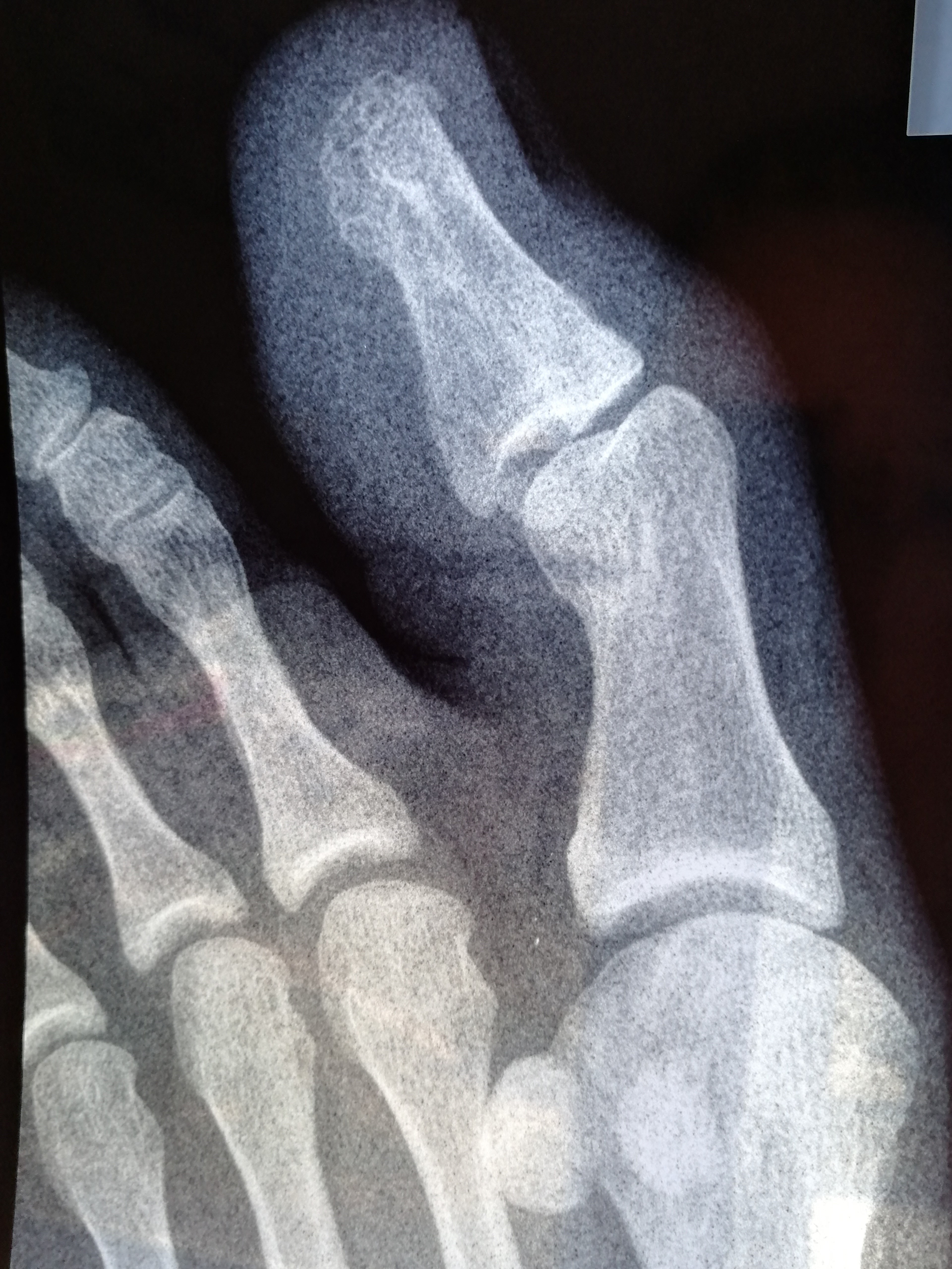 Ногтевая фаланга ноги. Краевой перелом проксимальной фаланги. Краевой перелом проксимальной фаланги 1 пальца стопы рентген. Краевой перелом фаланги рентген. Краевой перелом фаланги пальца рентген.