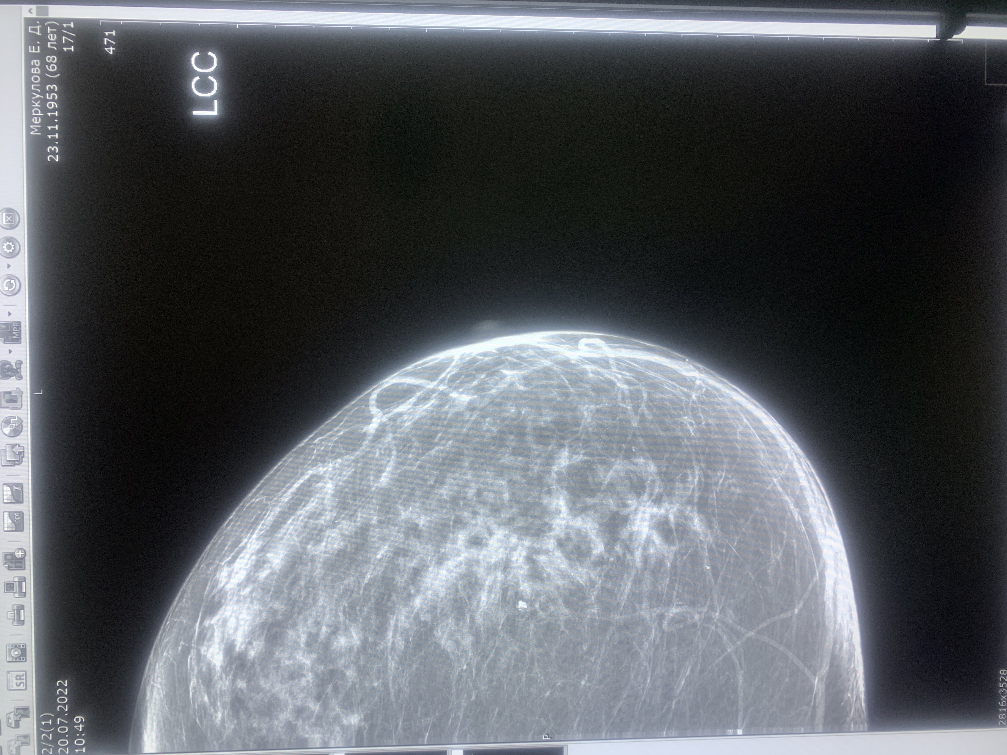 Фиброзно кистозная мастопатия маммограмма