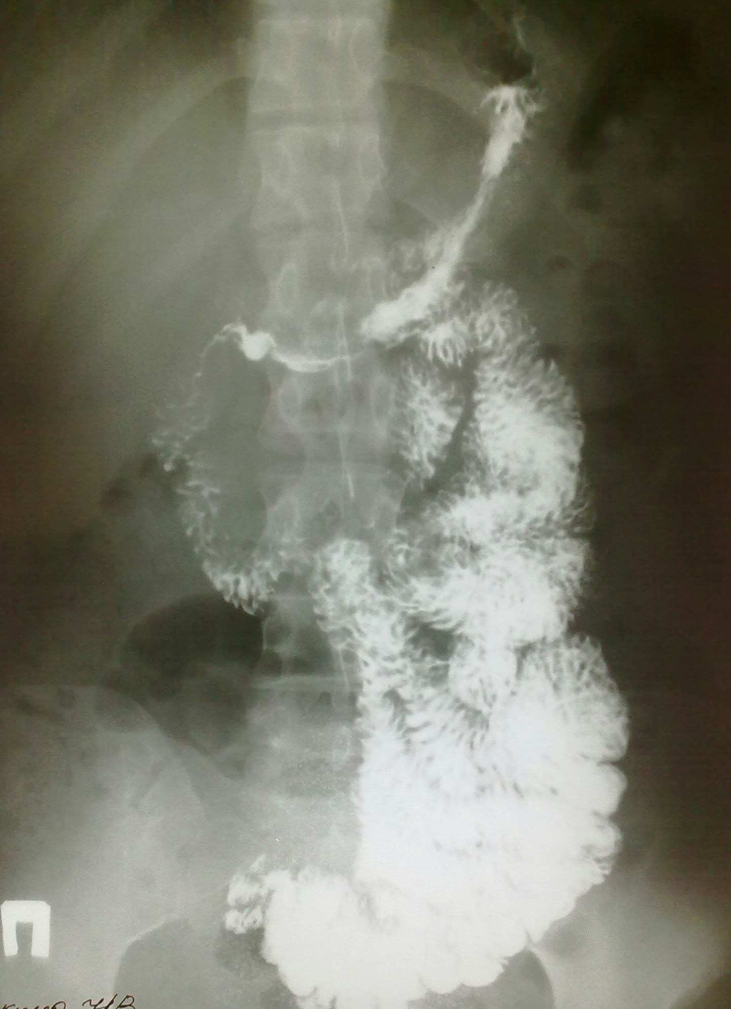 Рентген пассаж