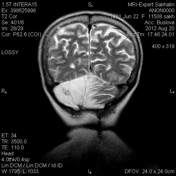 Гемисферы мозжечка изменение. Гемисферы мозжечка опухоль. Опухоль в левой гемисфере мозжечка. Правая гемисфера мозжечка. Астроцитома правой гемисферы мозжечка..