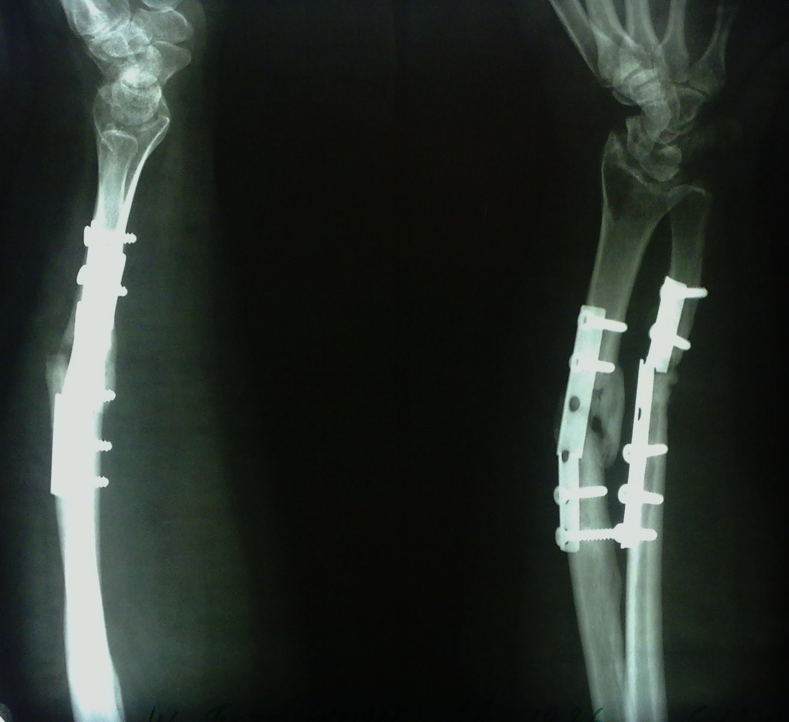 Рентгеновские пластины. Остеосинтез перелома лучевой кости. Рентген перелома кости предплечья. Остеосинтез дистального метаэпифиза лучевой кости пластиной. Переломы предплечья остеосинтез.