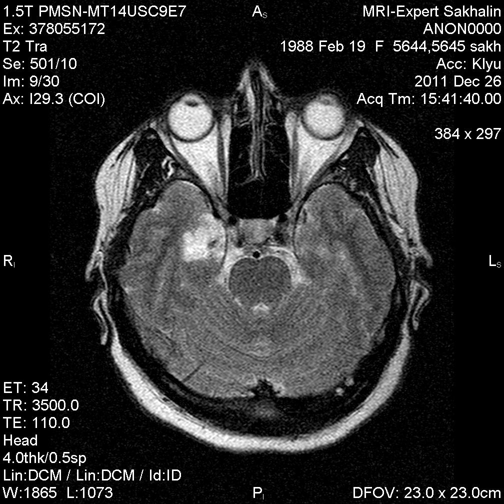 Мультинодулярная вакуолизирующая нейрональная опухоль мрт картинки